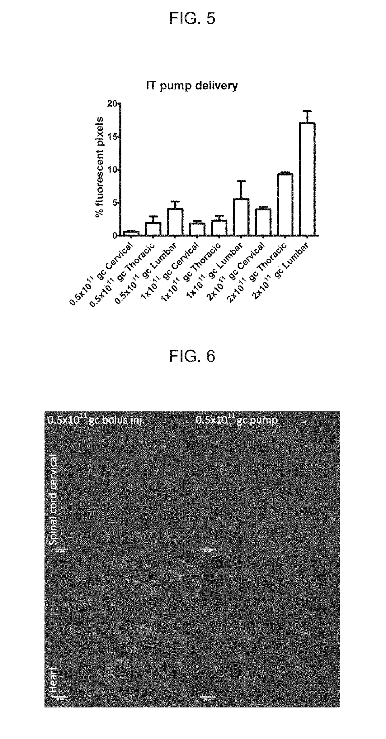 Intrathecal delivery of nucleic acid sequences encoding abcd1 for treatment of adrenomyeloneuropathy