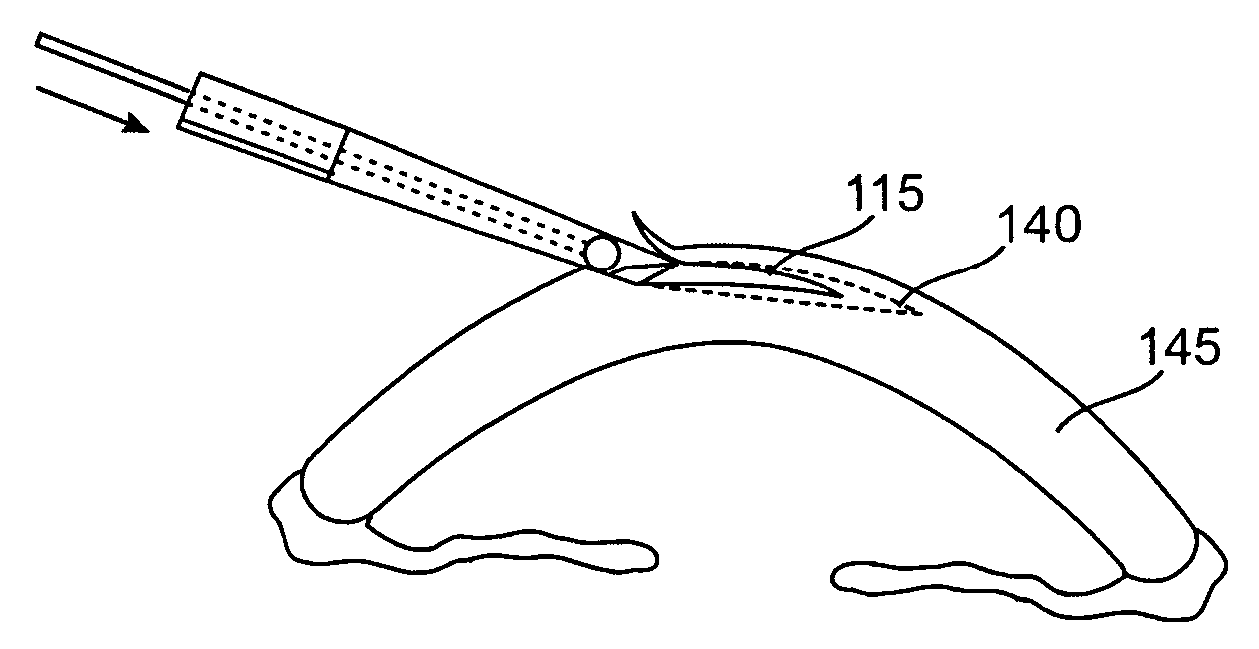 Corneal implants and methods and systems for placement