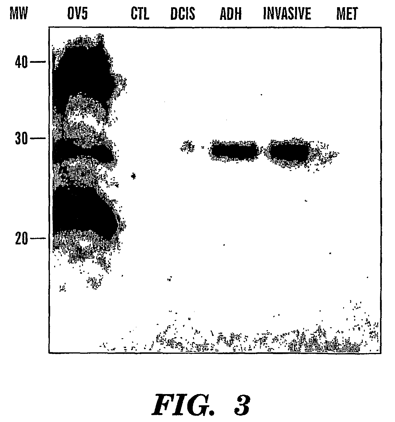 Cyr61 as a biomarker for diagnosis and prognosis of cancers of epithelial origin