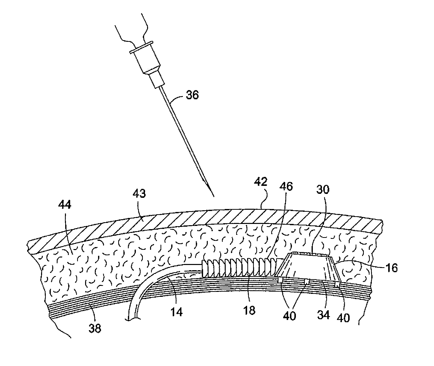 Over molded implantable device to protect tubing from puncture