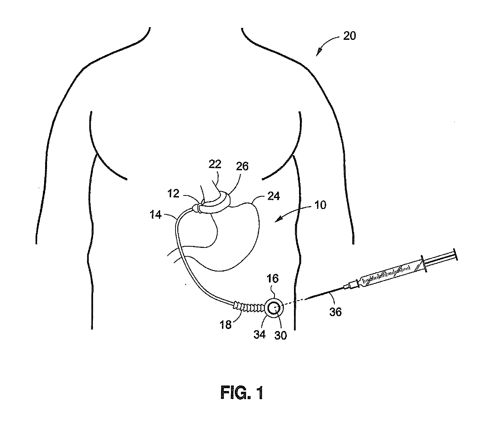 Over molded implantable device to protect tubing from puncture