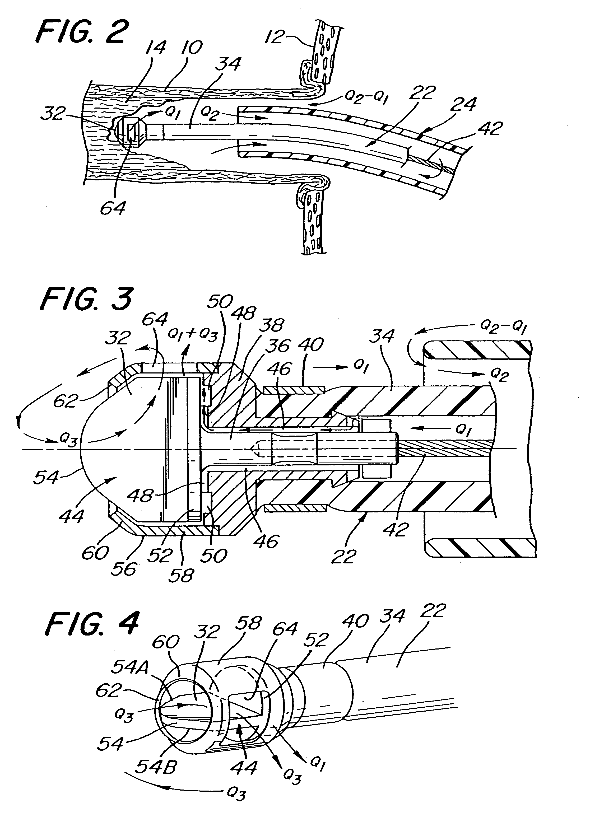 Method for opening a lumen in an occluded blood vessel