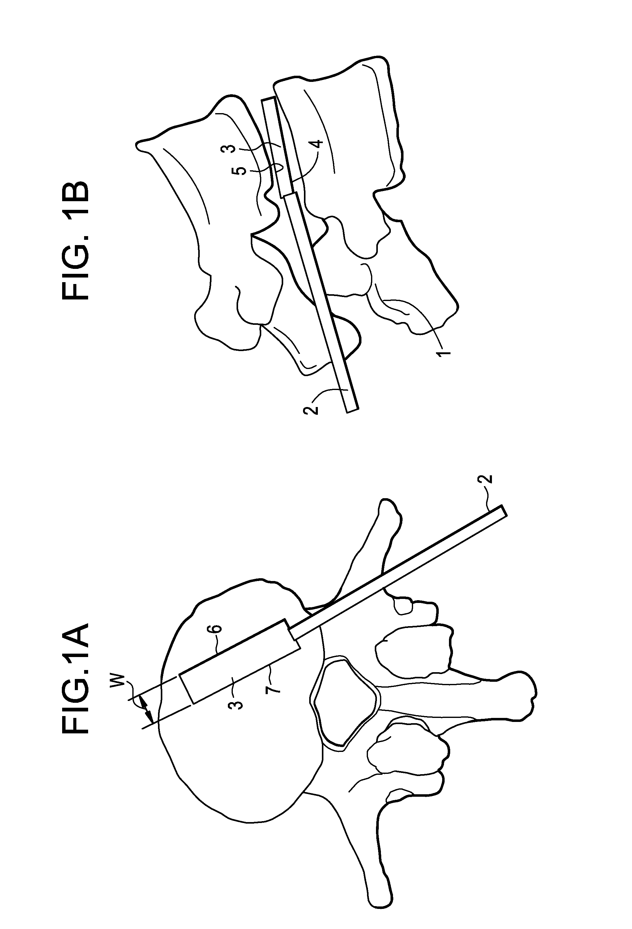 Balloon With Shape Control For Spinal Procedures