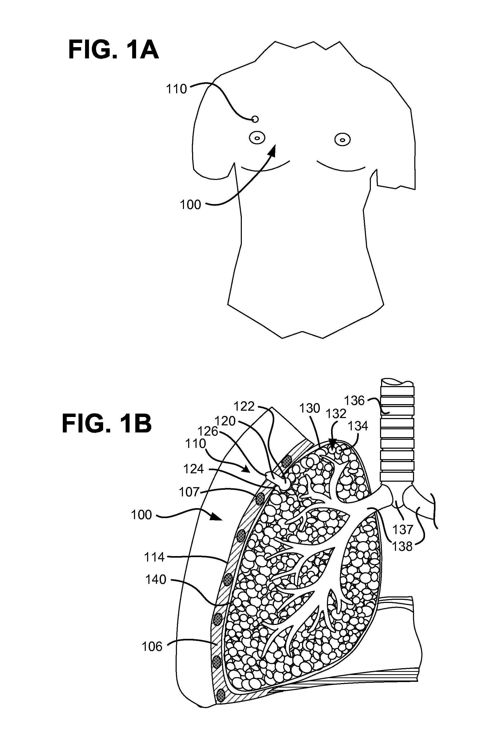 Pneumostoma management device and method for treatment of chronic obstructive pulmonary disease