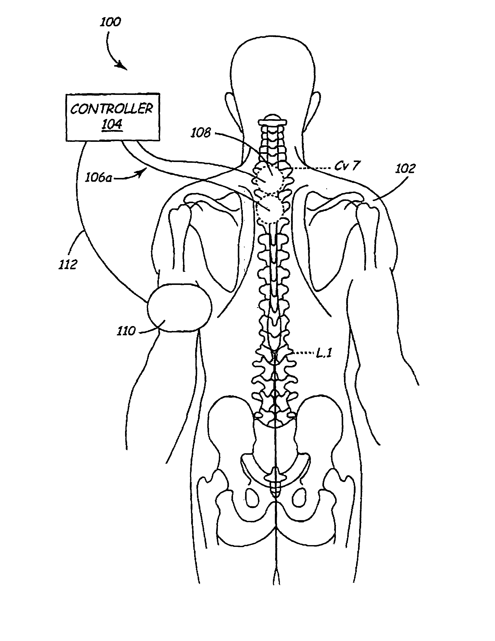 Method and apparatus to minimize effects of a cardiac insult