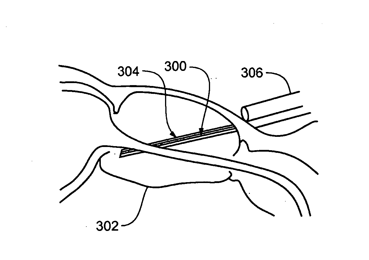 Tissue infusion system and method