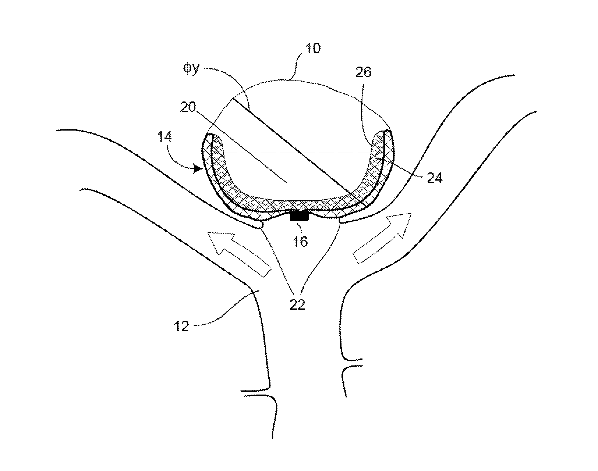 Occlusion Device