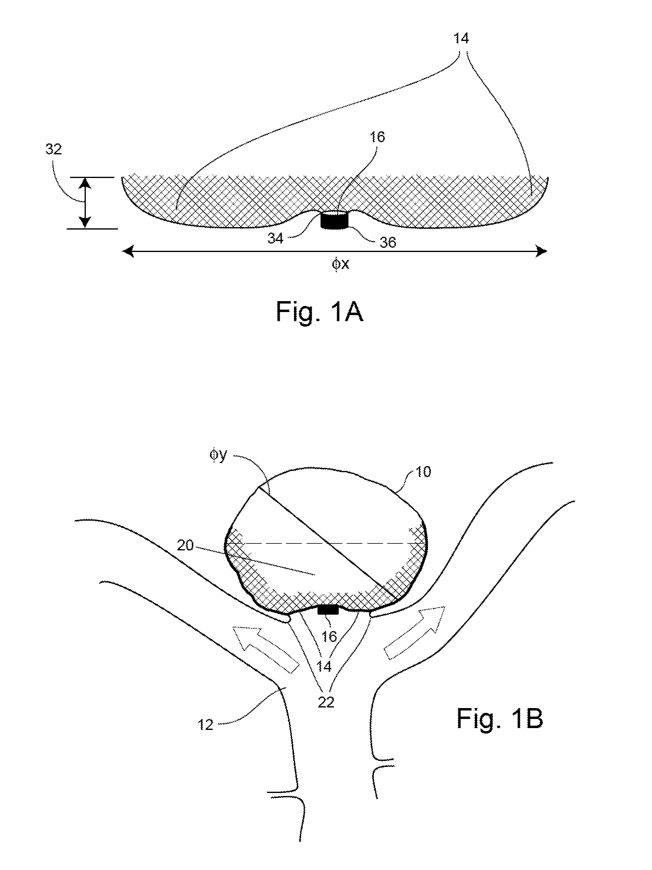 Occlusion Device
