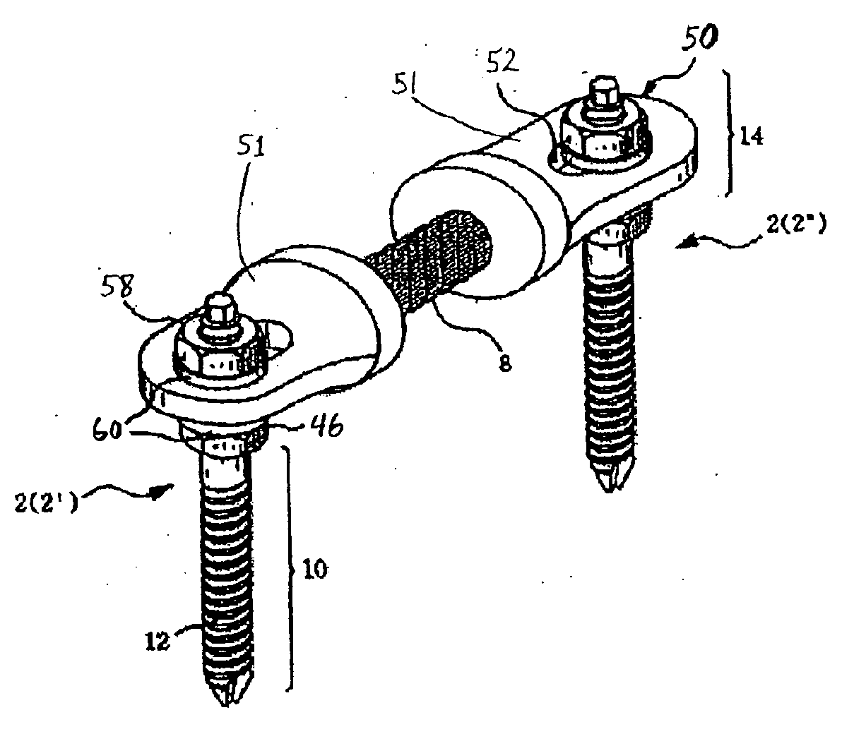 Spinal Stabilization Device