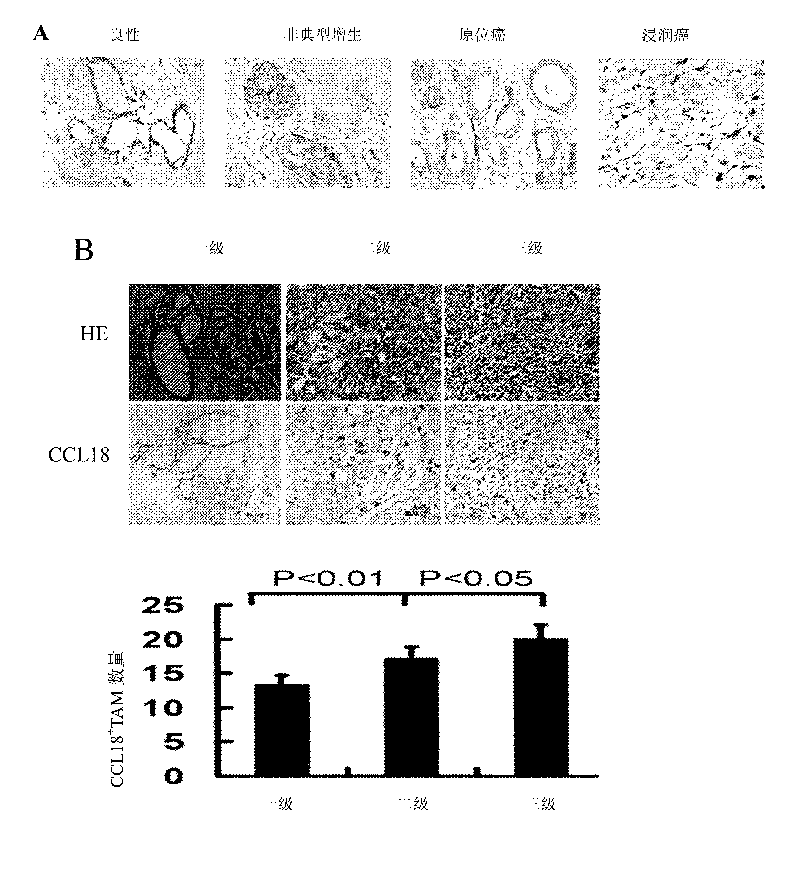 Method for restraining infiltration and metastasis of breast cancer cells by using target CCL 18 and application thereof