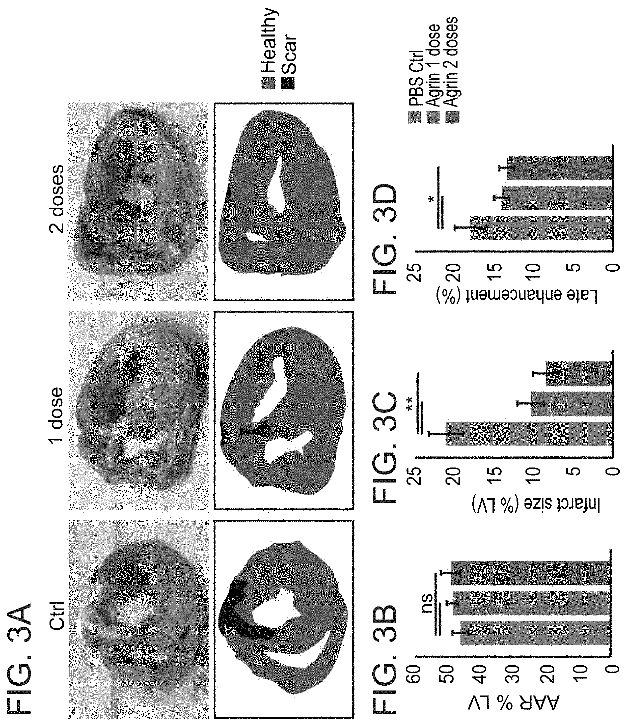 Treatment of an ischemic heart disease