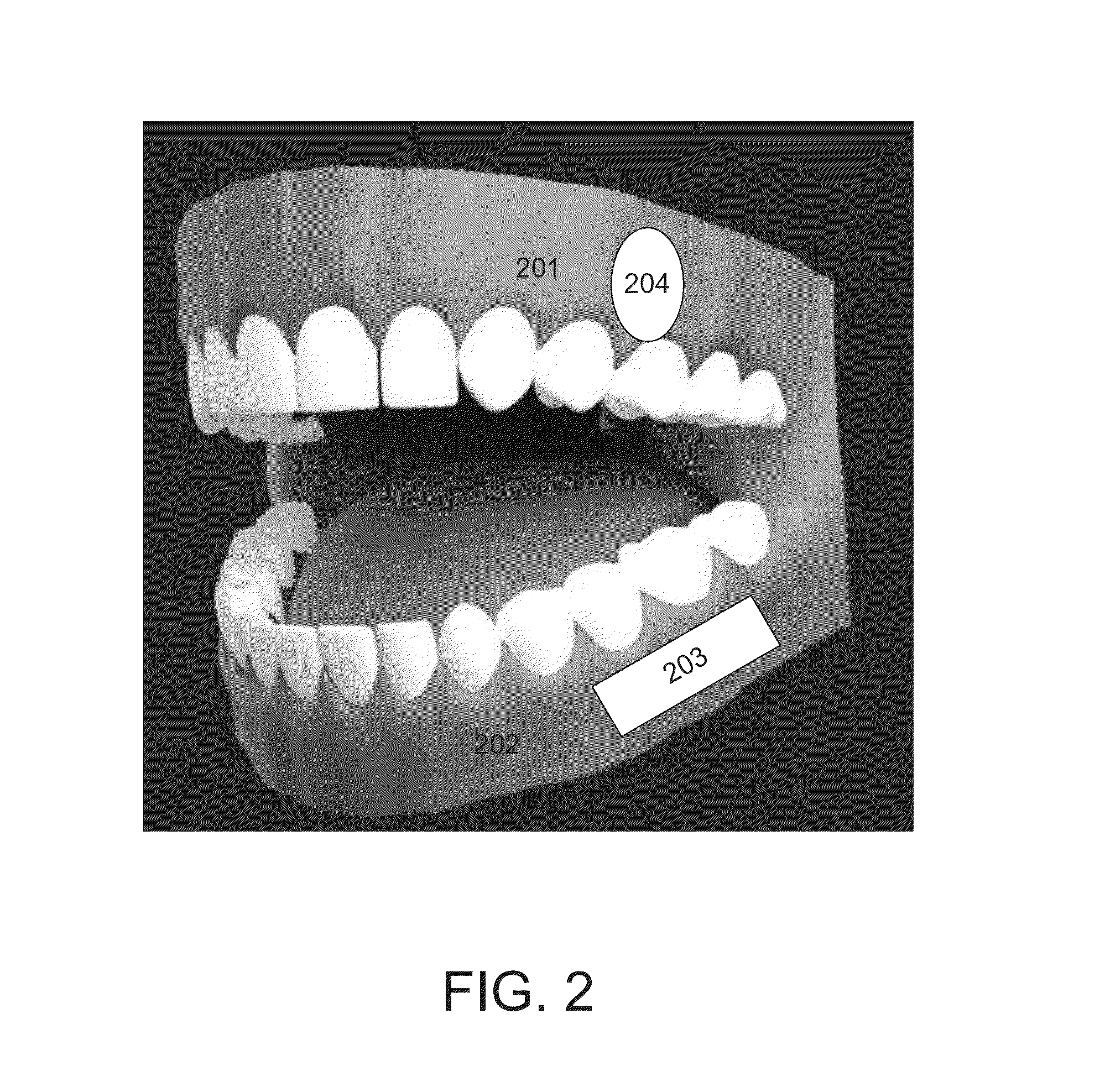 Oral anesthesia application