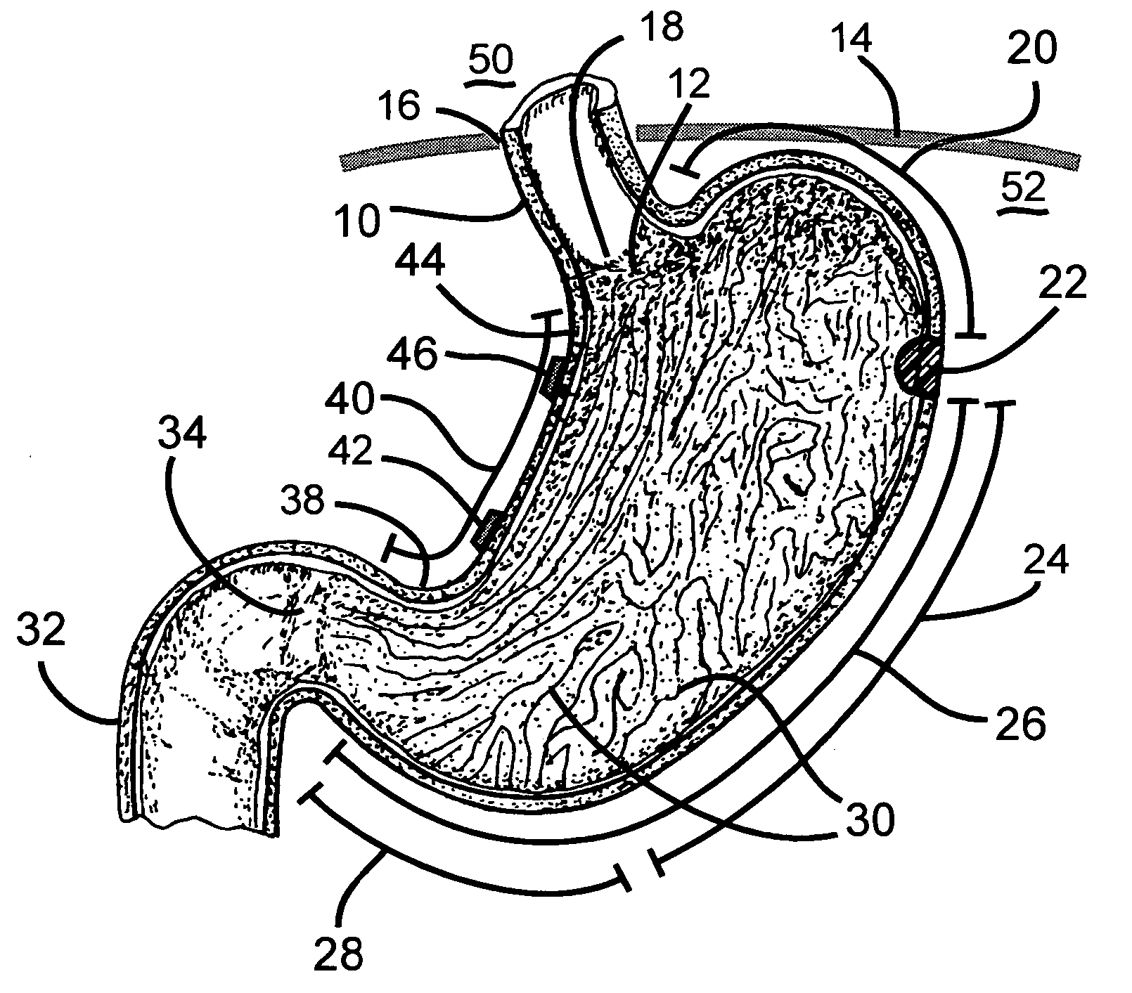 Process and electrostimulation device for treating obesity and/or gastroesophageal reflux disease