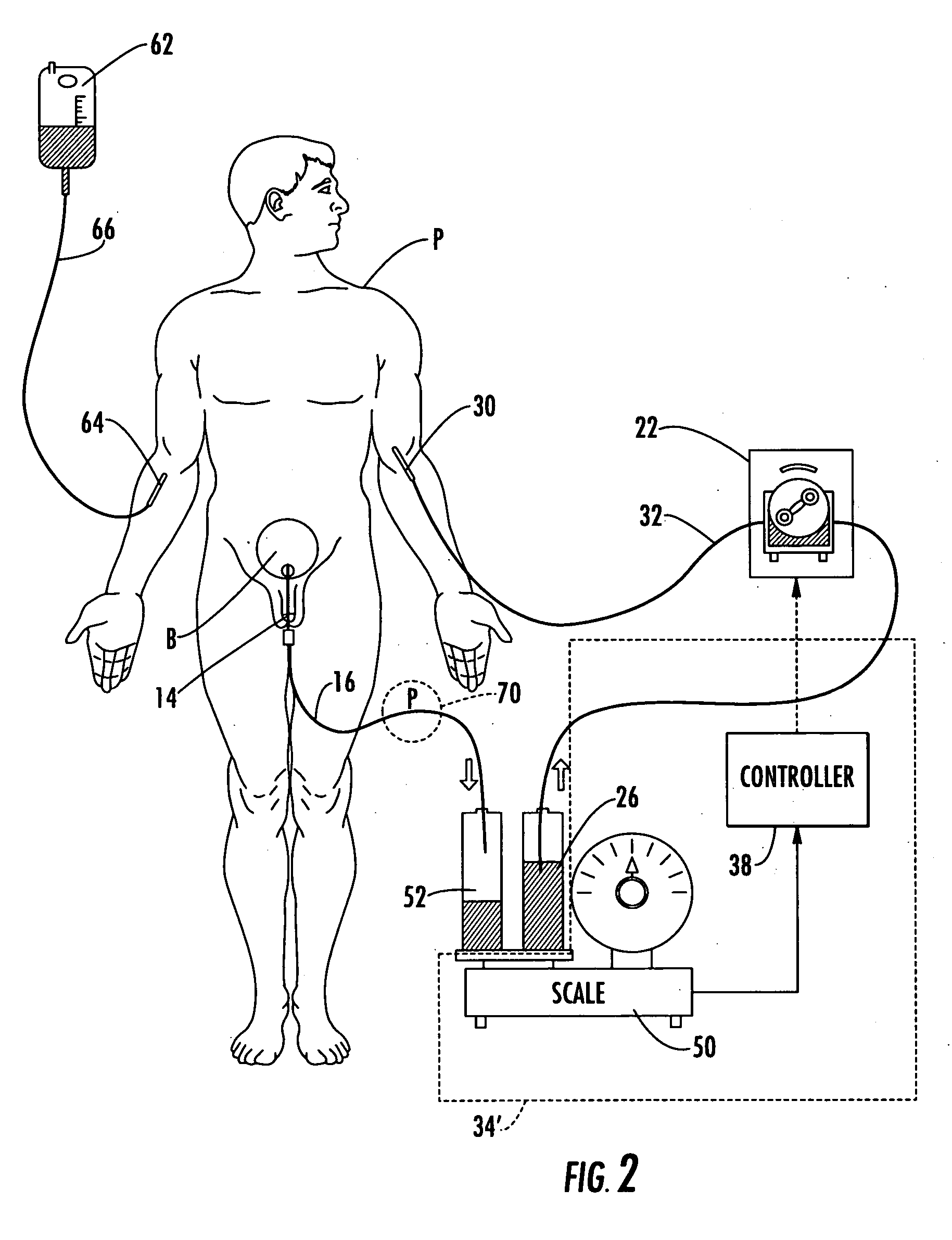 Patient hydration system with a redundant monitoring of hydration fluid infusion