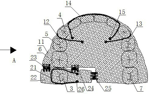 Maxillary occlusal pad type molar retractor in the replacement dentition period