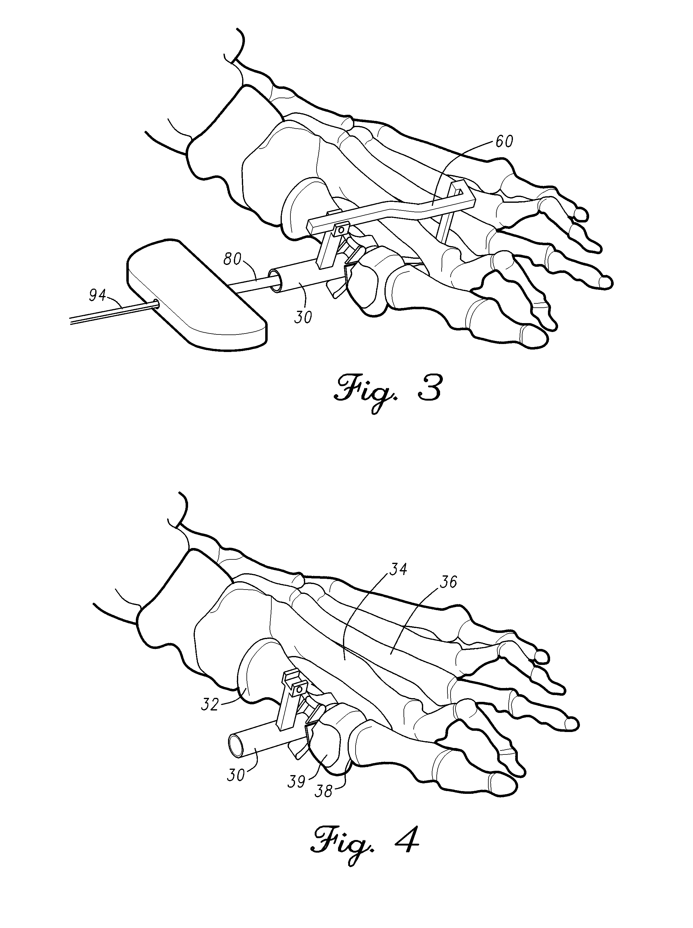 Methods and devices for treating a structural bone and joint deformity