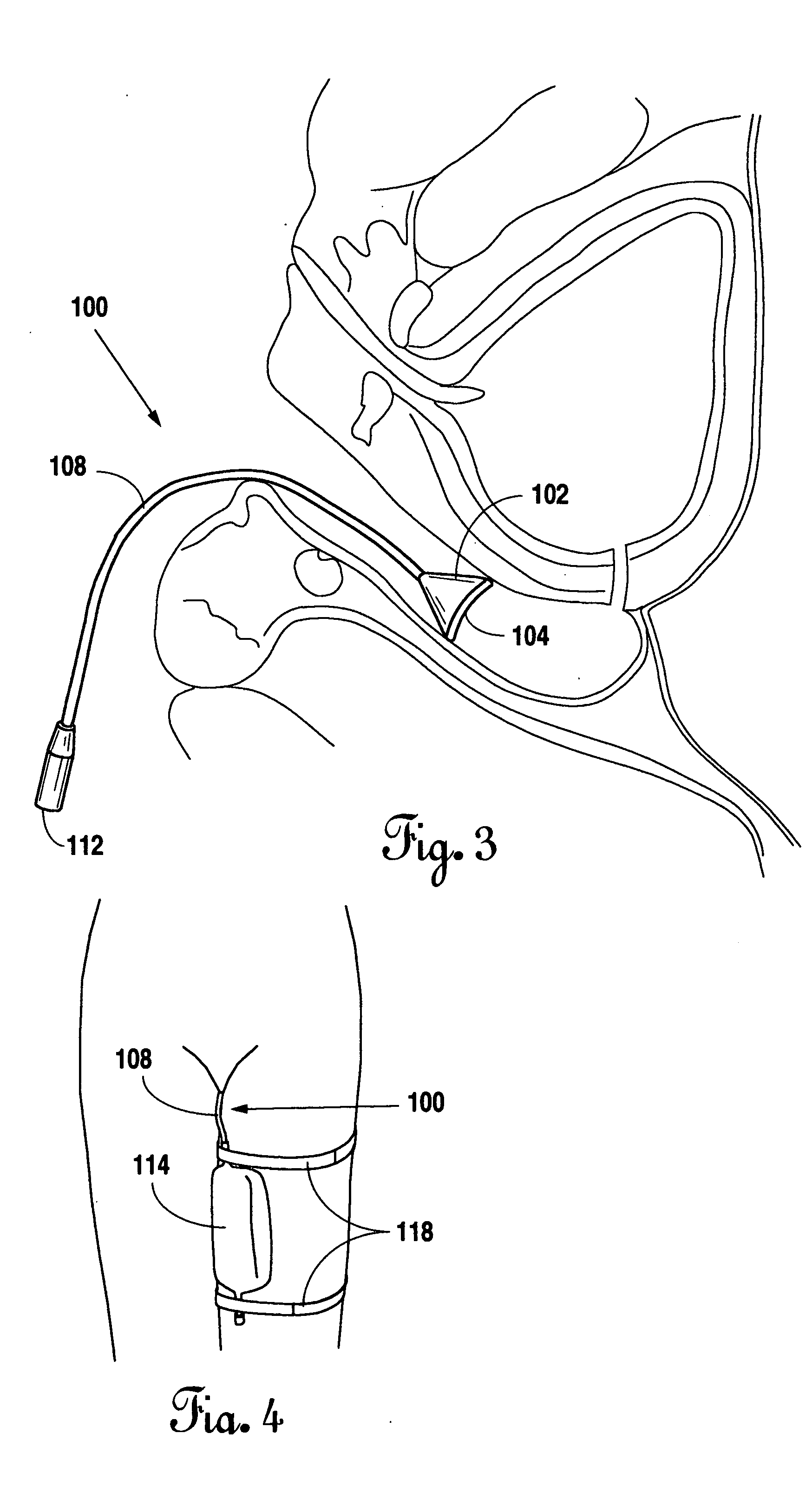 Vesicovaginal incontinence device and method of use