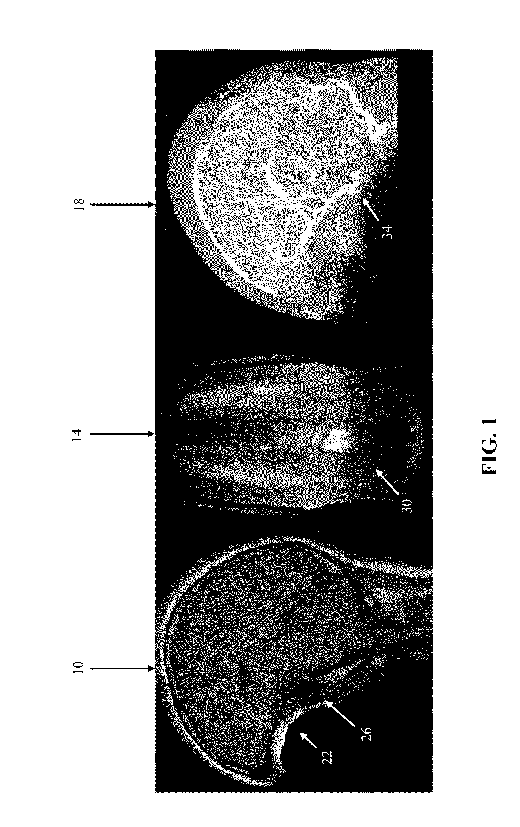 Apparatuses and Methods for Cancellation of Inhomogeneous Magnetic Fields Induced by Non-Biological Materials Within a Patient's Mouth During Magnetic Resonance Imaging