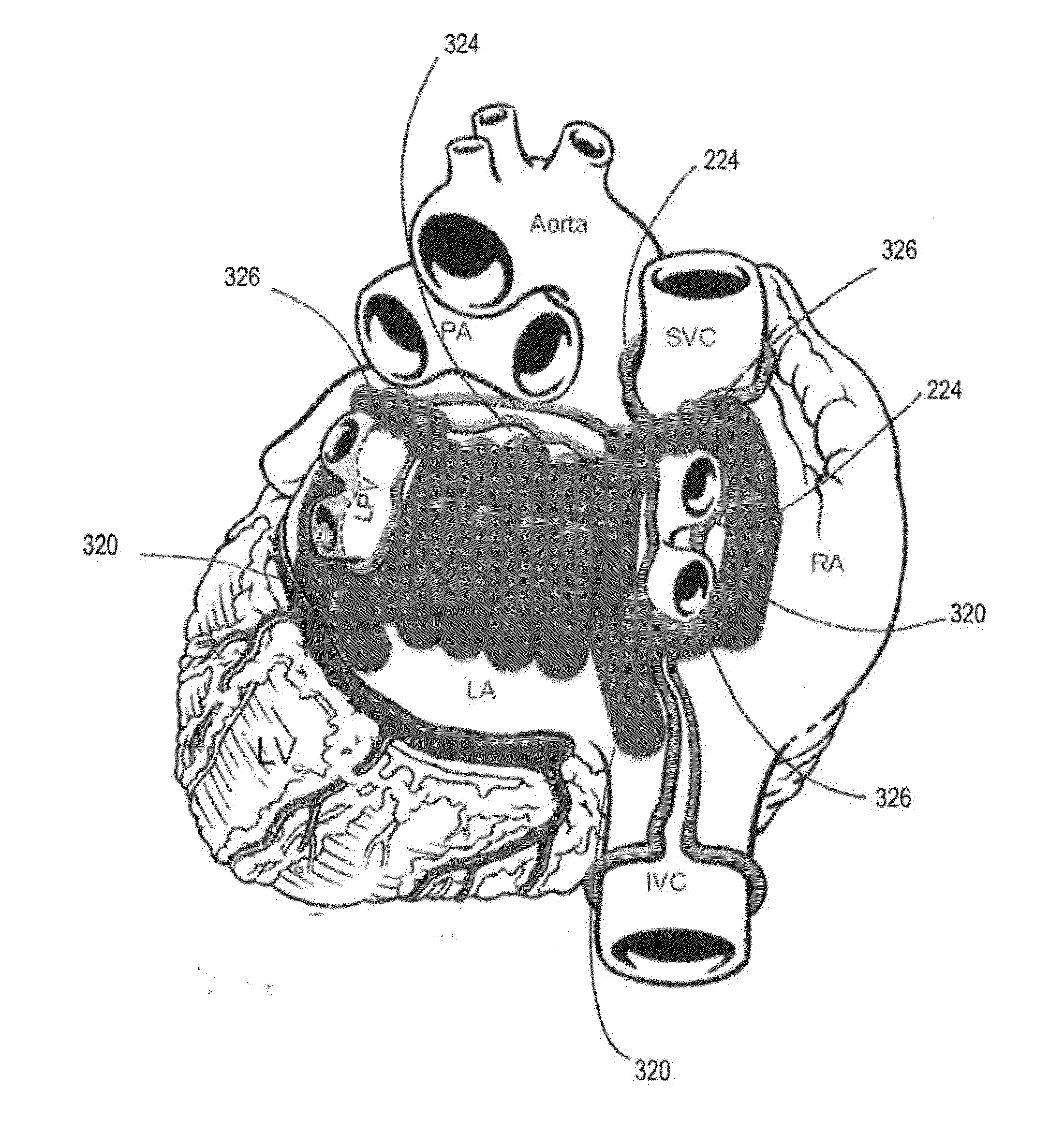 Methods to prevent stress remodeling of atrial tissue