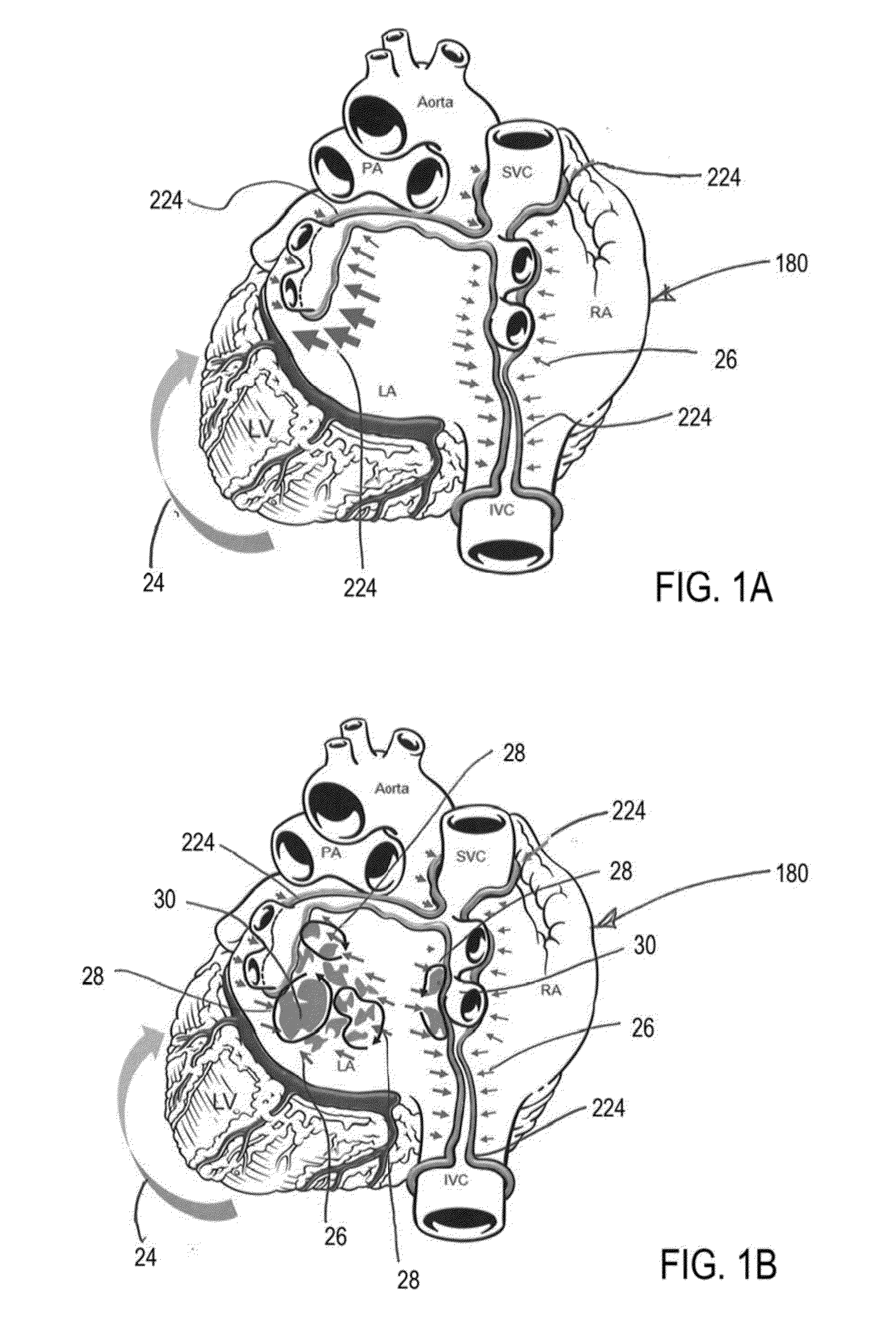 Methods to prevent stress remodeling of atrial tissue