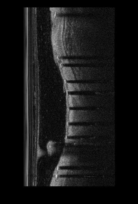 Coronary artery endovascular stent detection method and system based on OCT (Optical Coherence Tomography) image