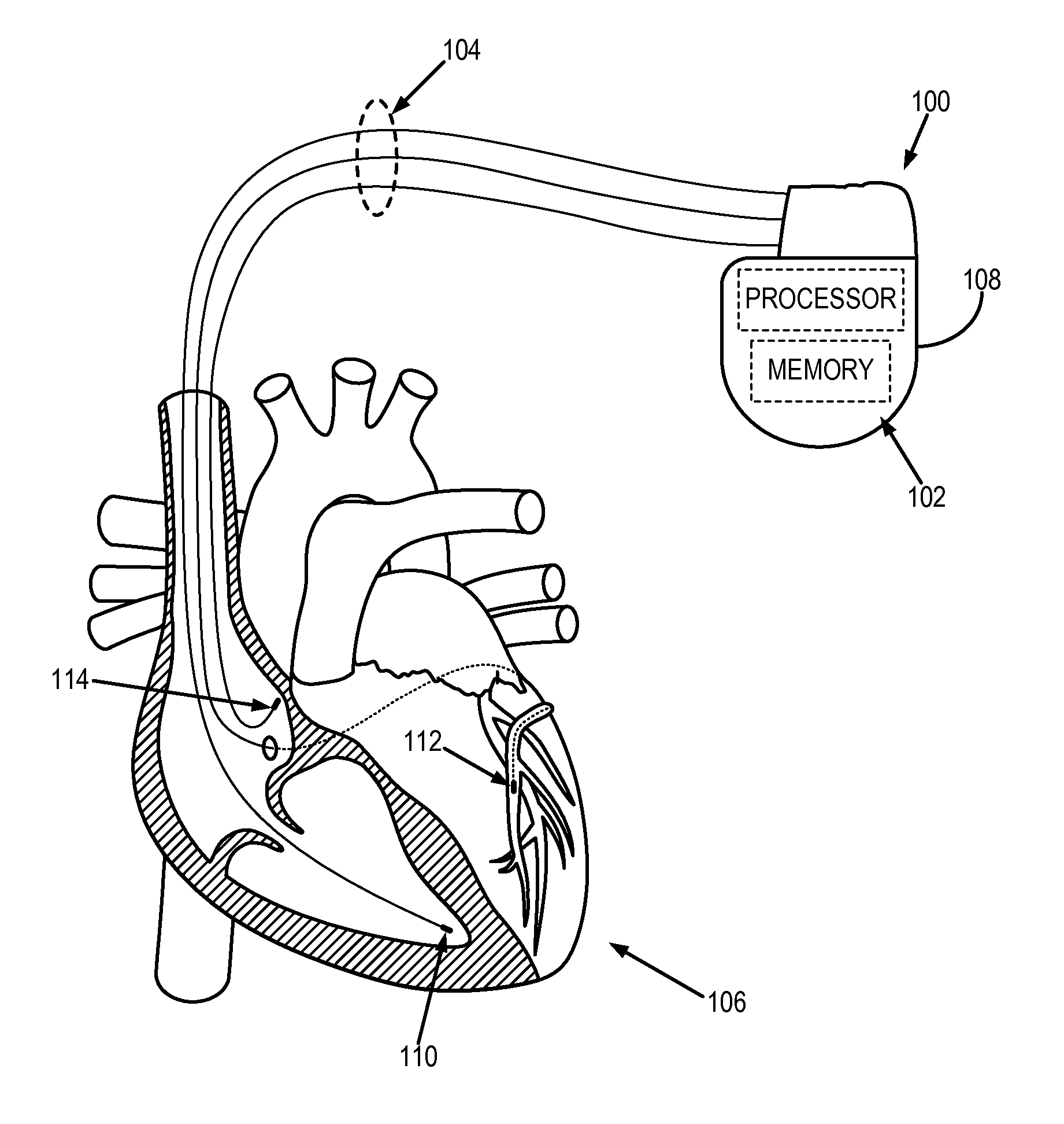 System and method for automated adjustment of cardiac resynchronization therapy control parameters