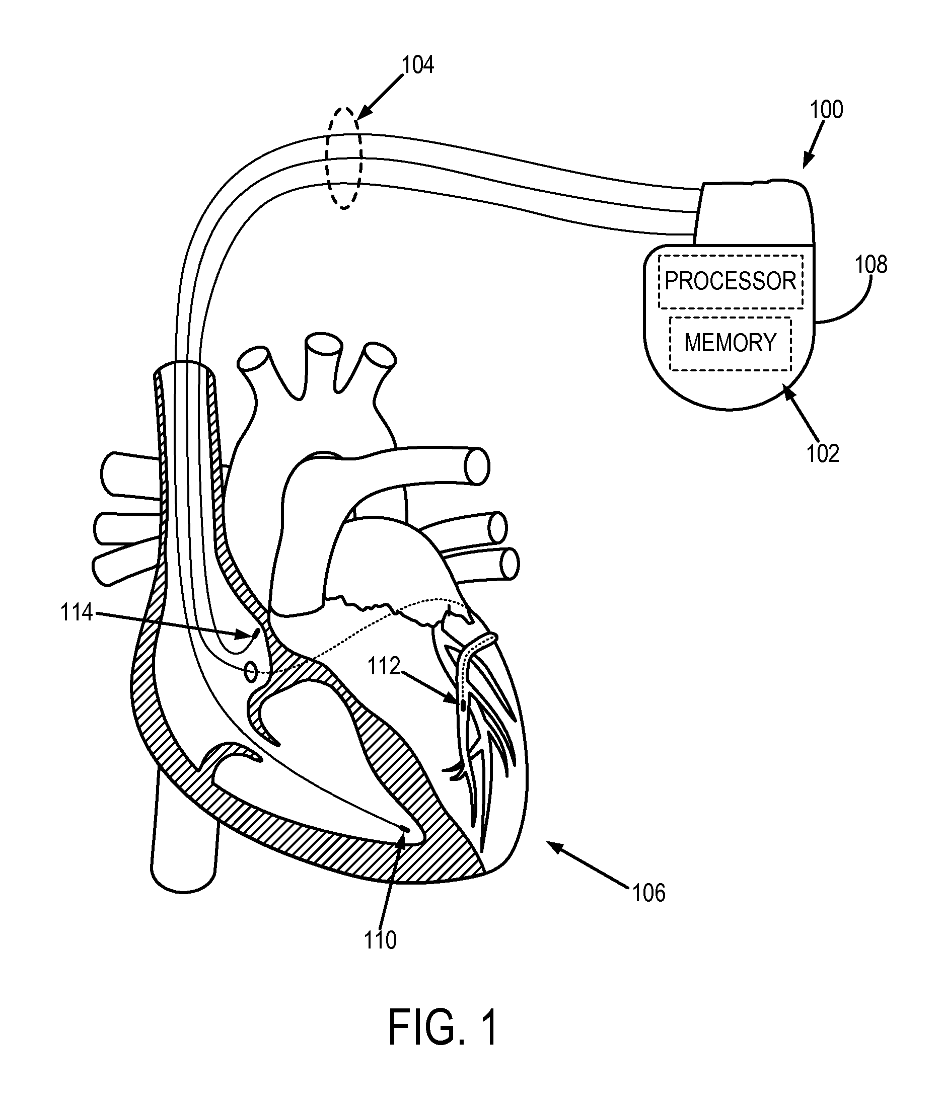 System and method for automated adjustment of cardiac resynchronization therapy control parameters