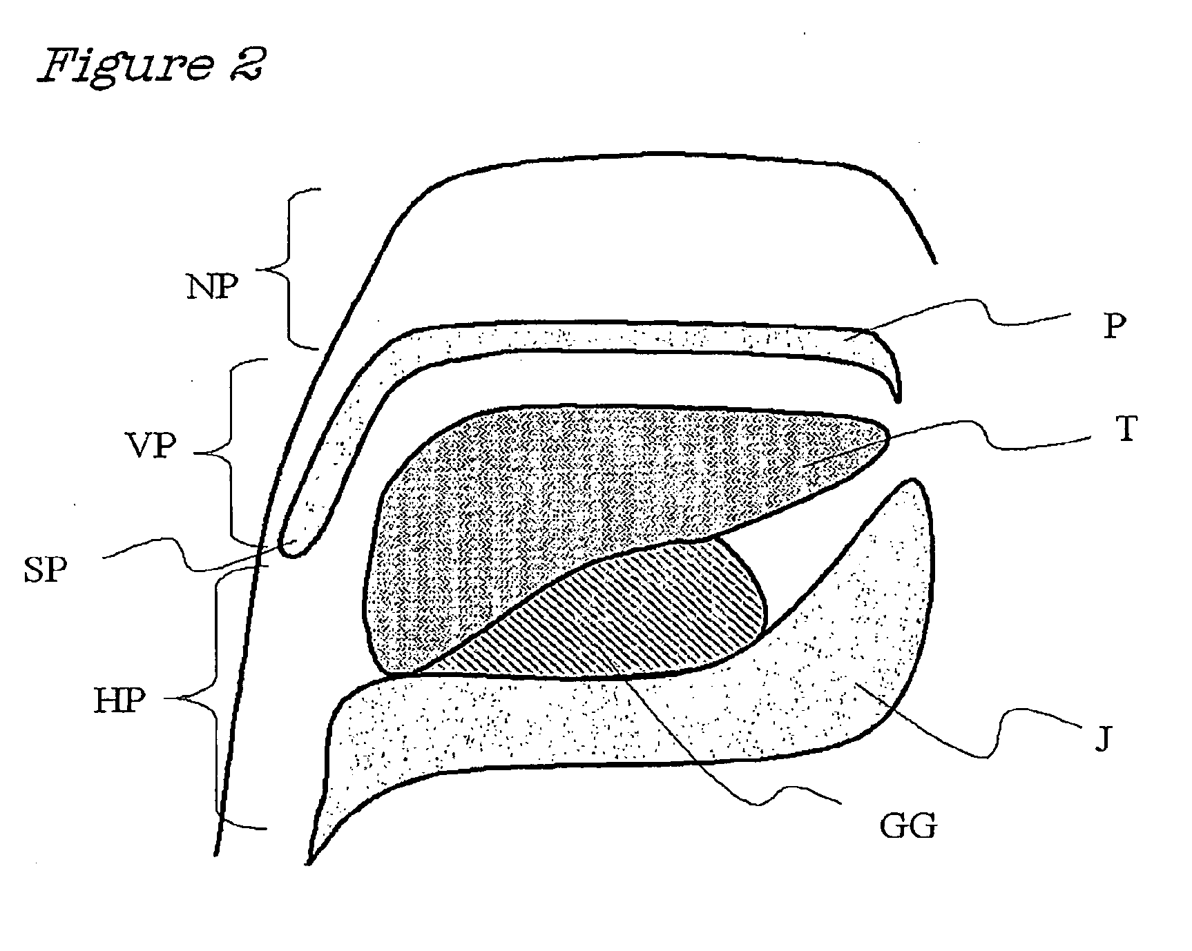 Method and Device for the Treatment of Obstructive Sleep Apnea and Snoring