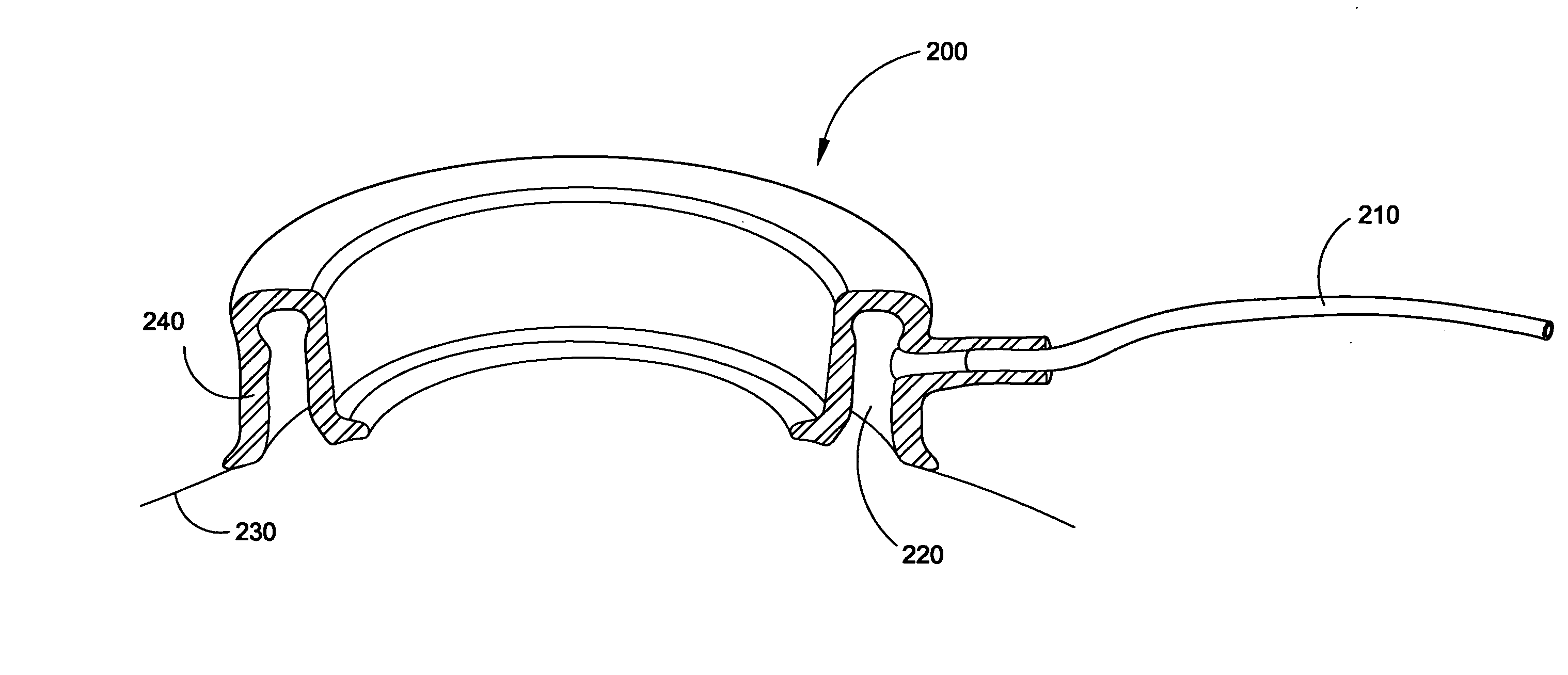 Conductive Keratoplasty Probe Guide Device and Methods Thereof