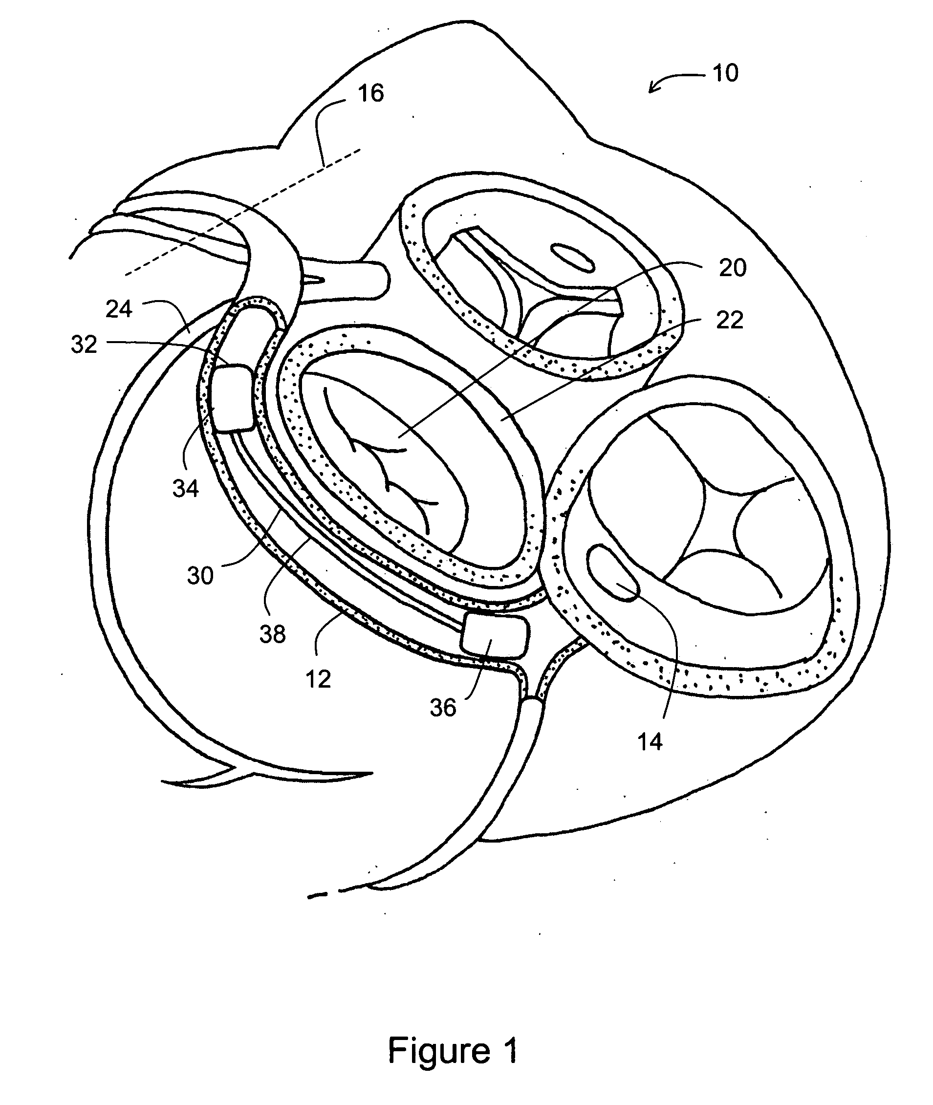 Tissue shaping device with integral connector and crimp