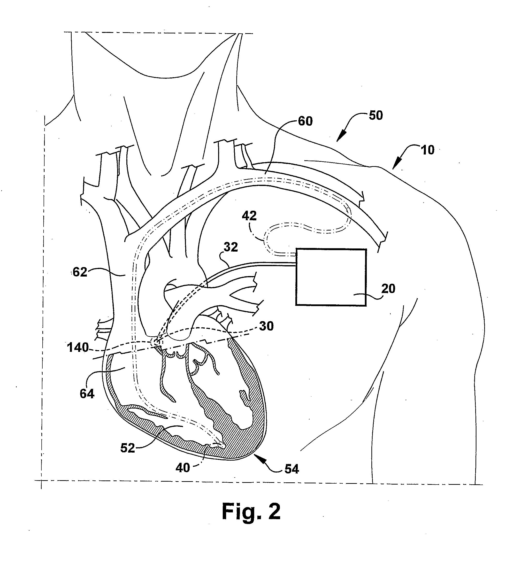 System and Method for Achieving Regular Slow Ventricular Rhythm in Response to Atrial Fibrillation