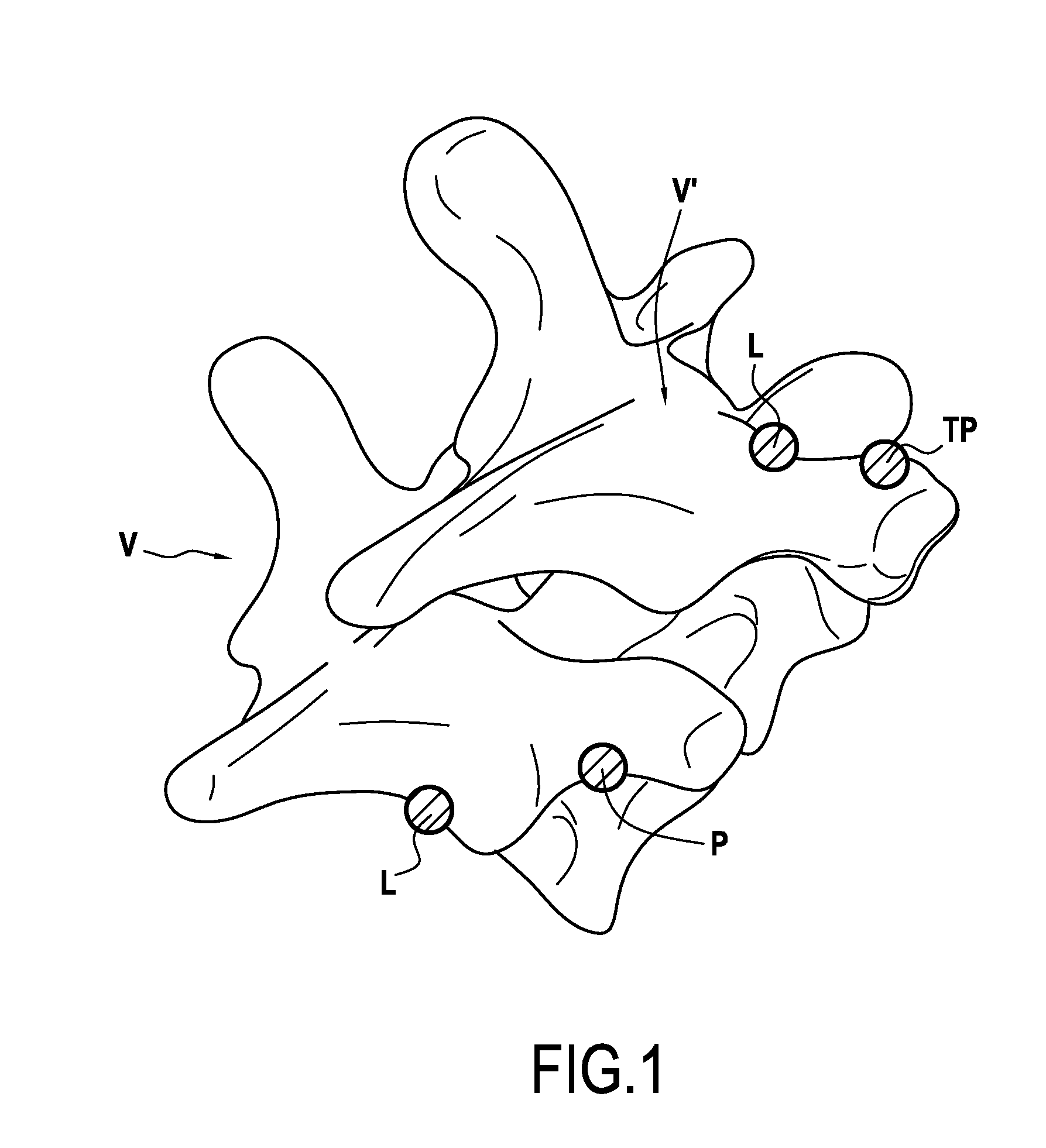 Orthopaedic device and methods for its pre-assembly and assembly