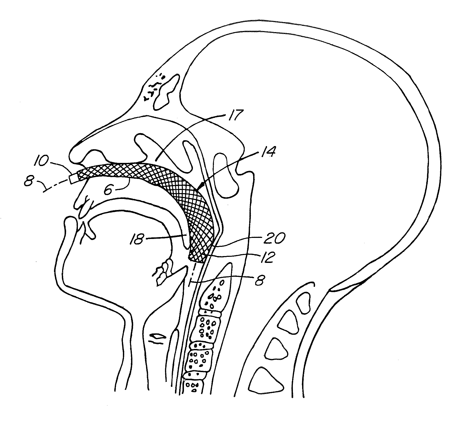 Upper Airway Device and Method