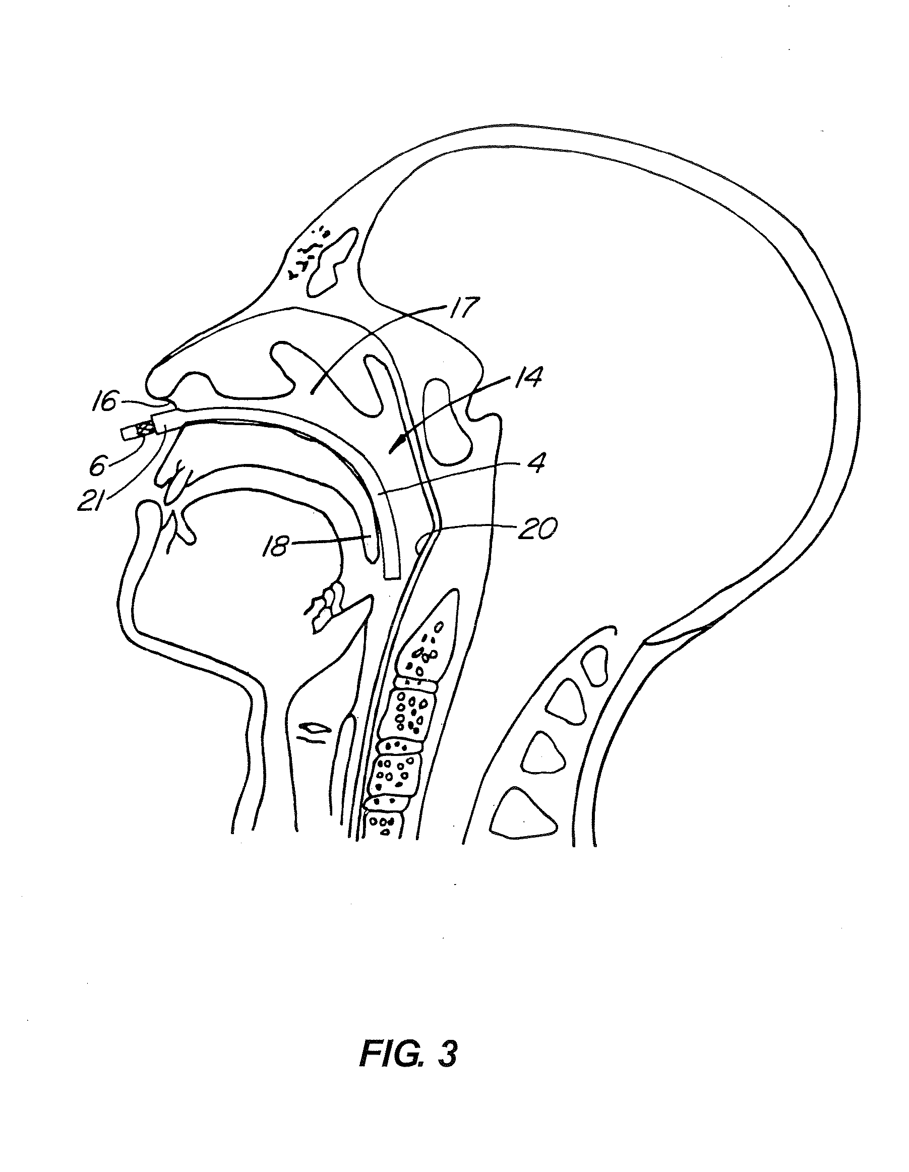 Upper Airway Device and Method