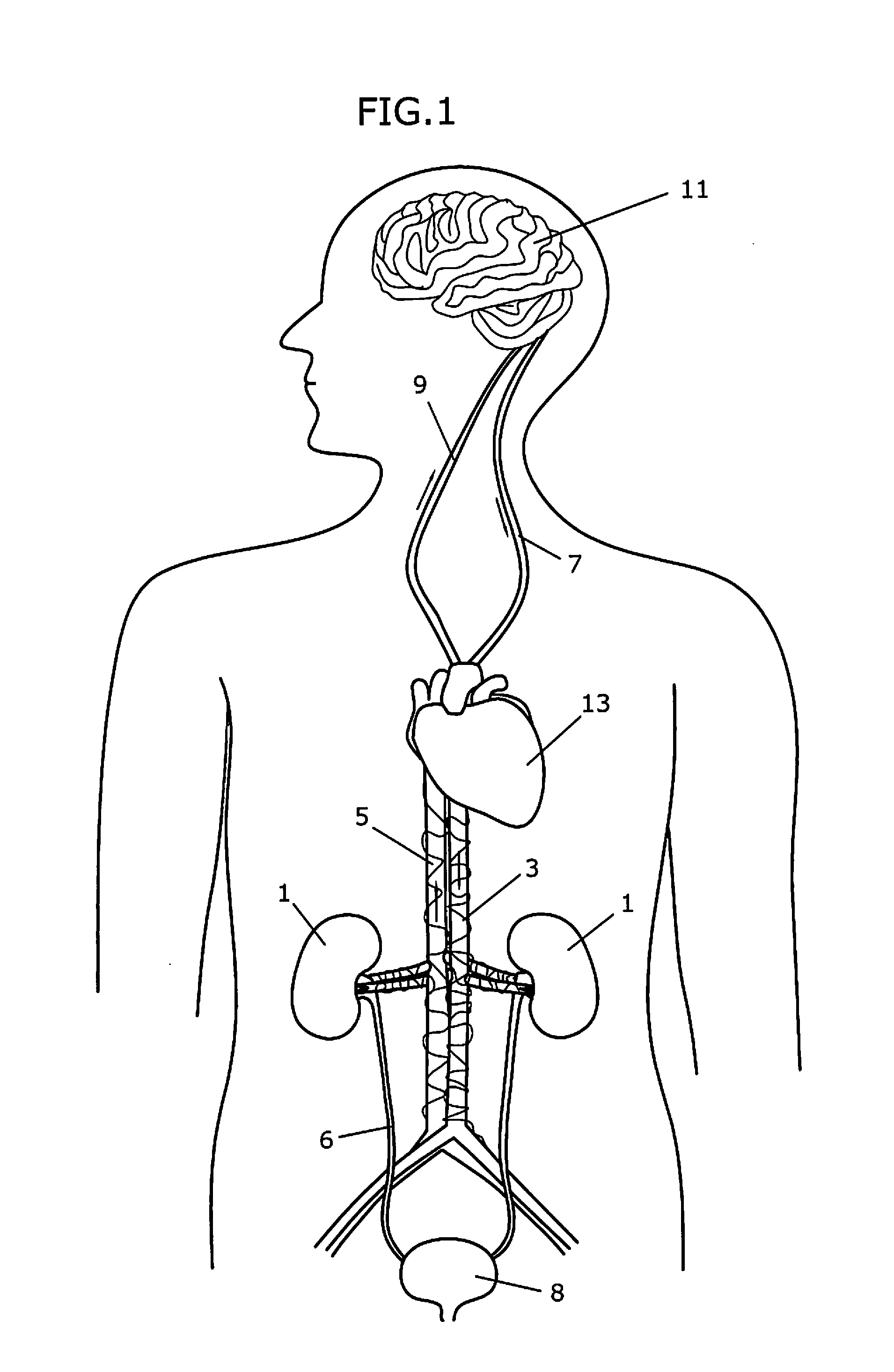 Apparatus and method for radiation treatment of a desired area in the renal vascular system of a patient