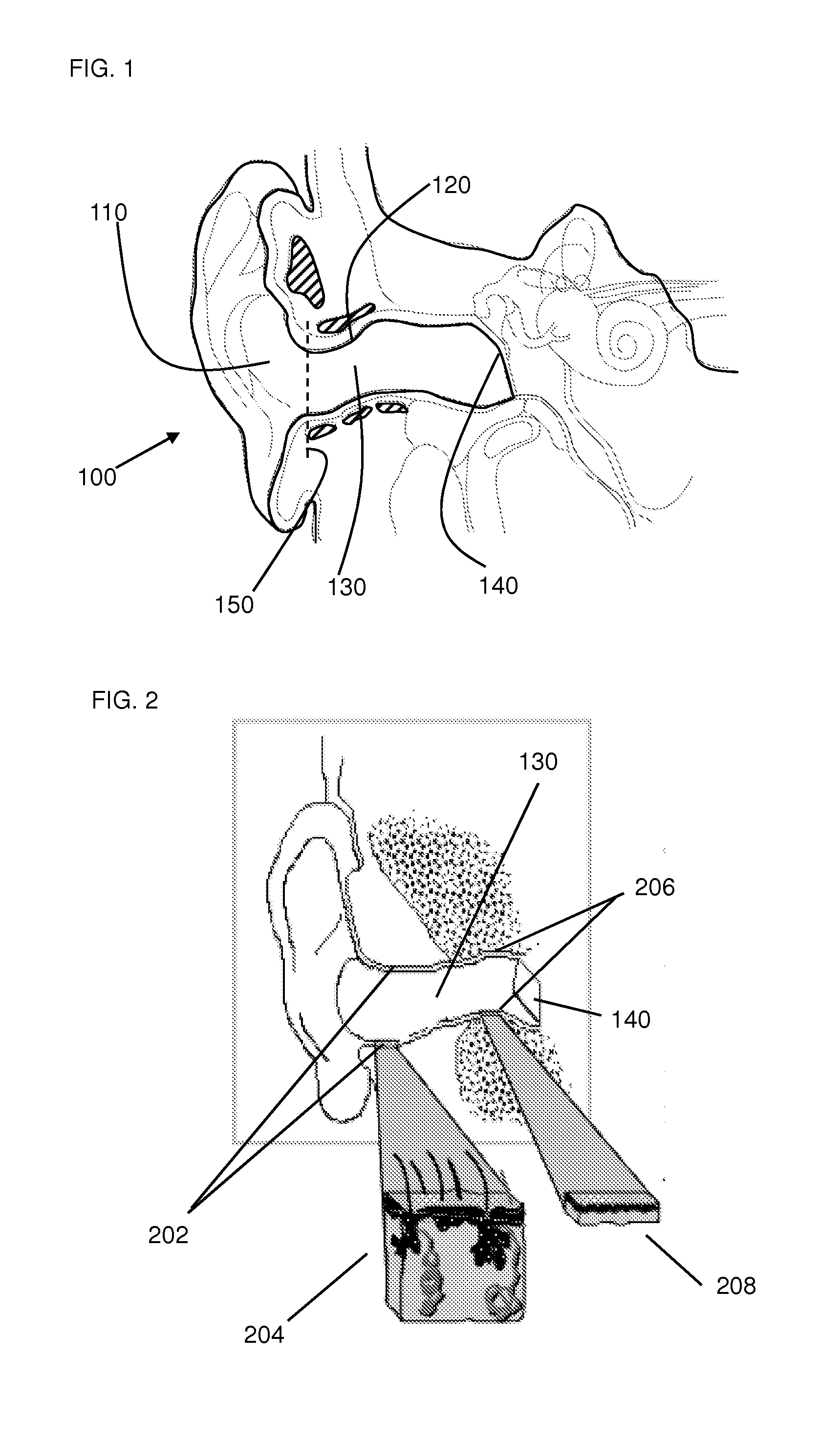 Method and Device for Acoustic Sealing