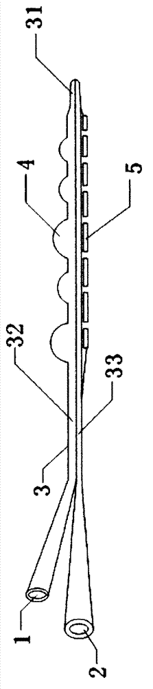 Beaded Eccentric Balloon Thrombolysis Catheter for Iiliofemoral Deep Vein Thrombosis