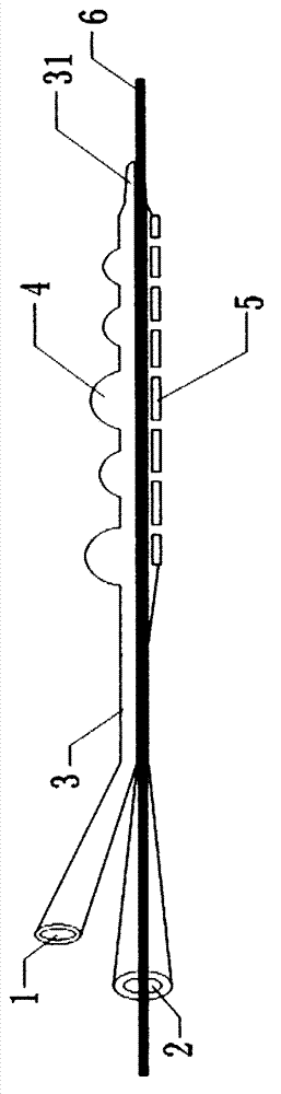 Beaded Eccentric Balloon Thrombolysis Catheter for Iiliofemoral Deep Vein Thrombosis