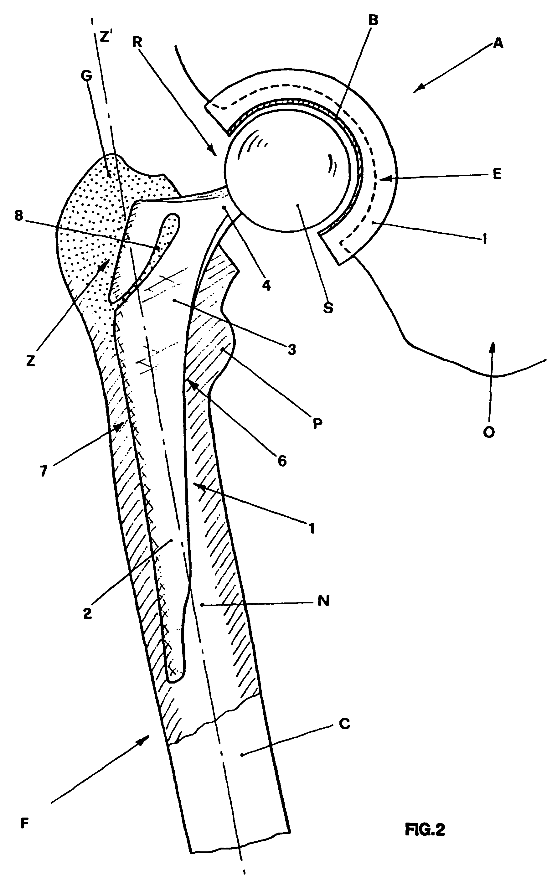 Femoral stem for hip prosthesis