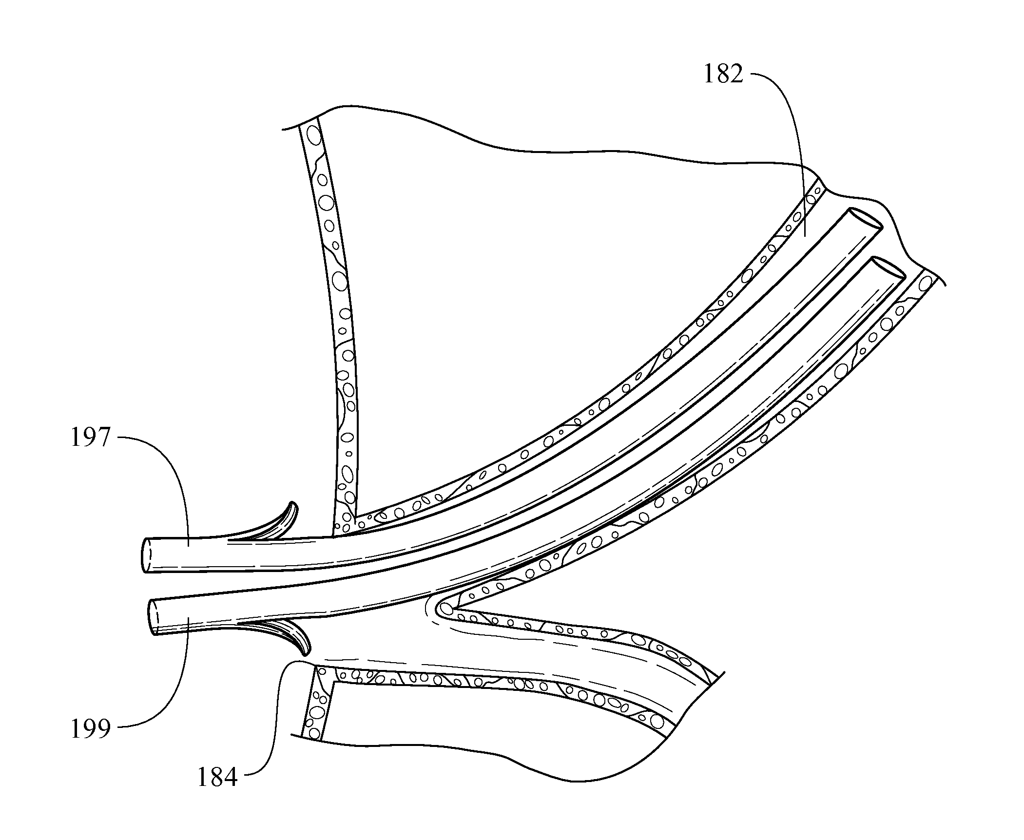 Method of placing multiple biliary stents without re-intervention, and device for same