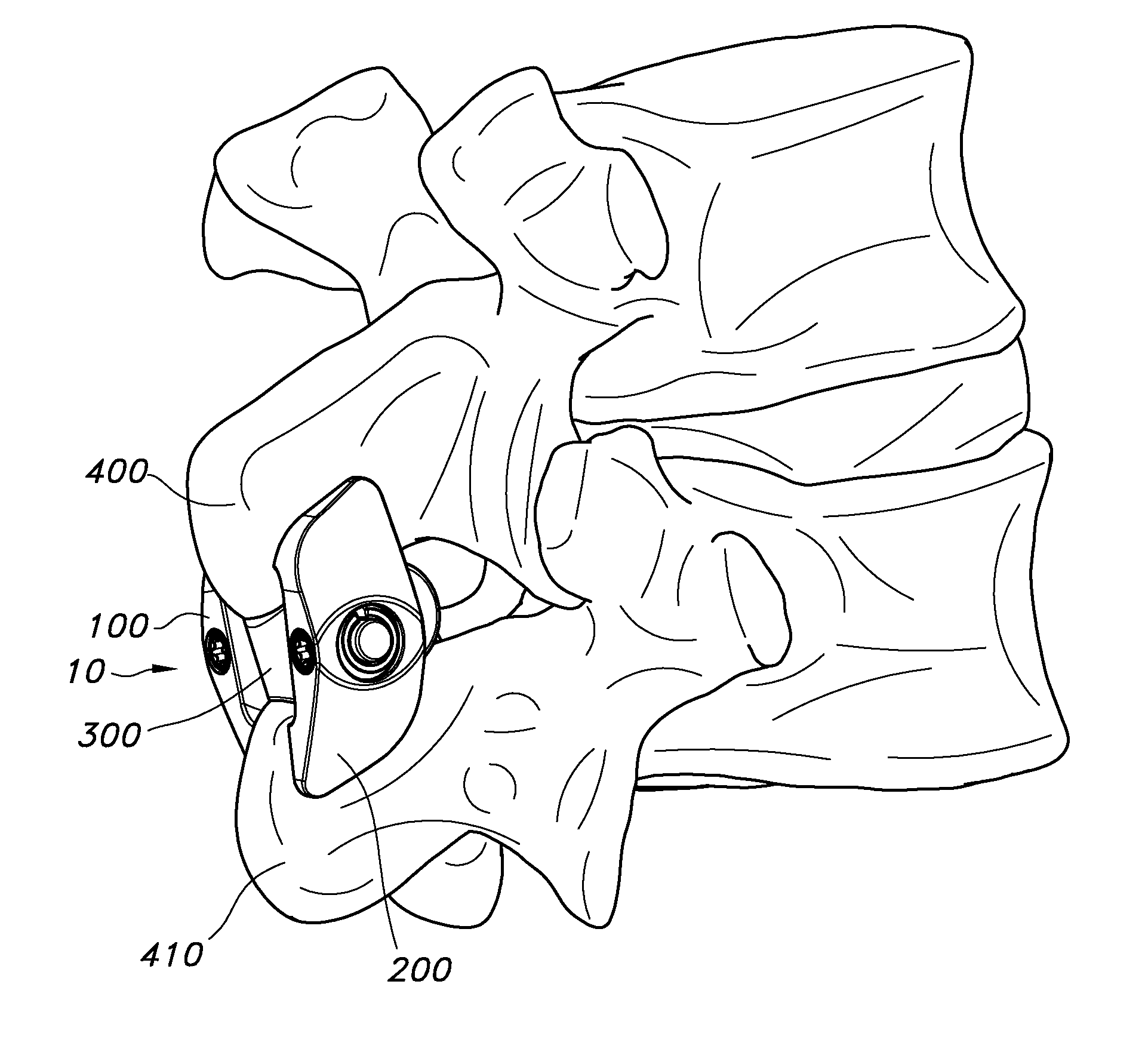 Spinous process fixation apparatus and method