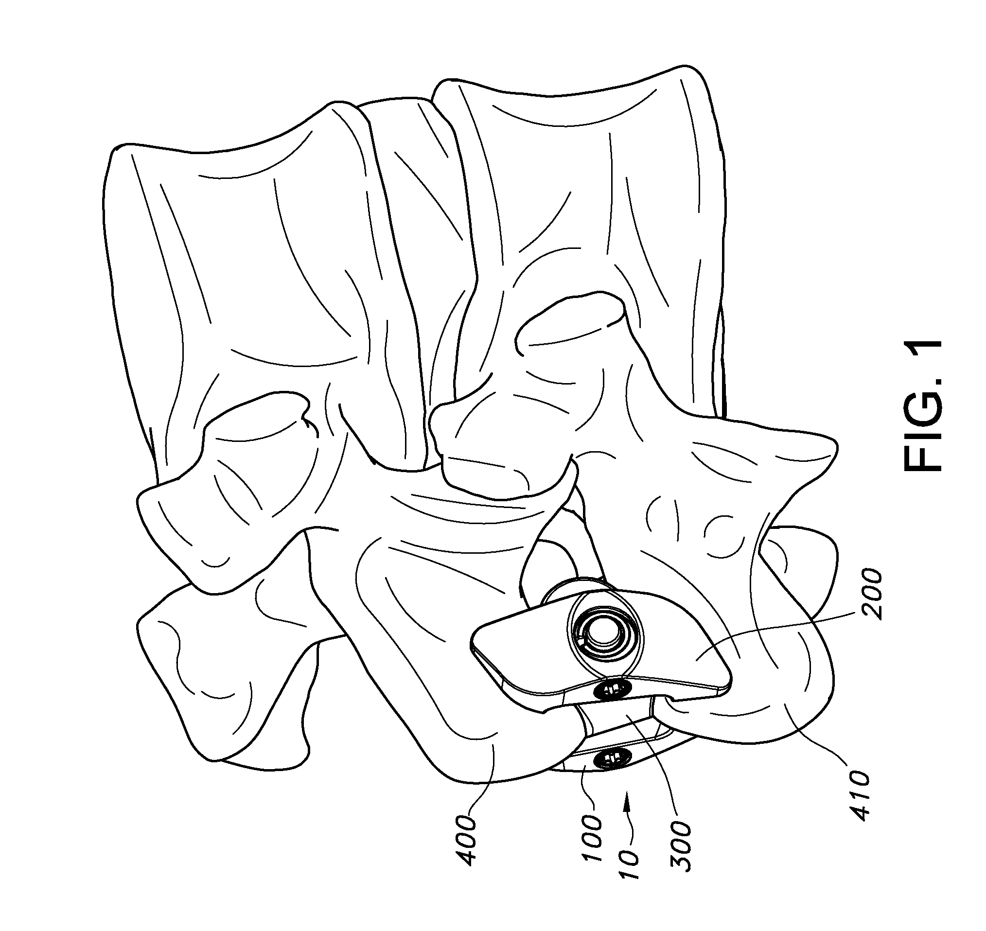 Spinous process fixation apparatus and method