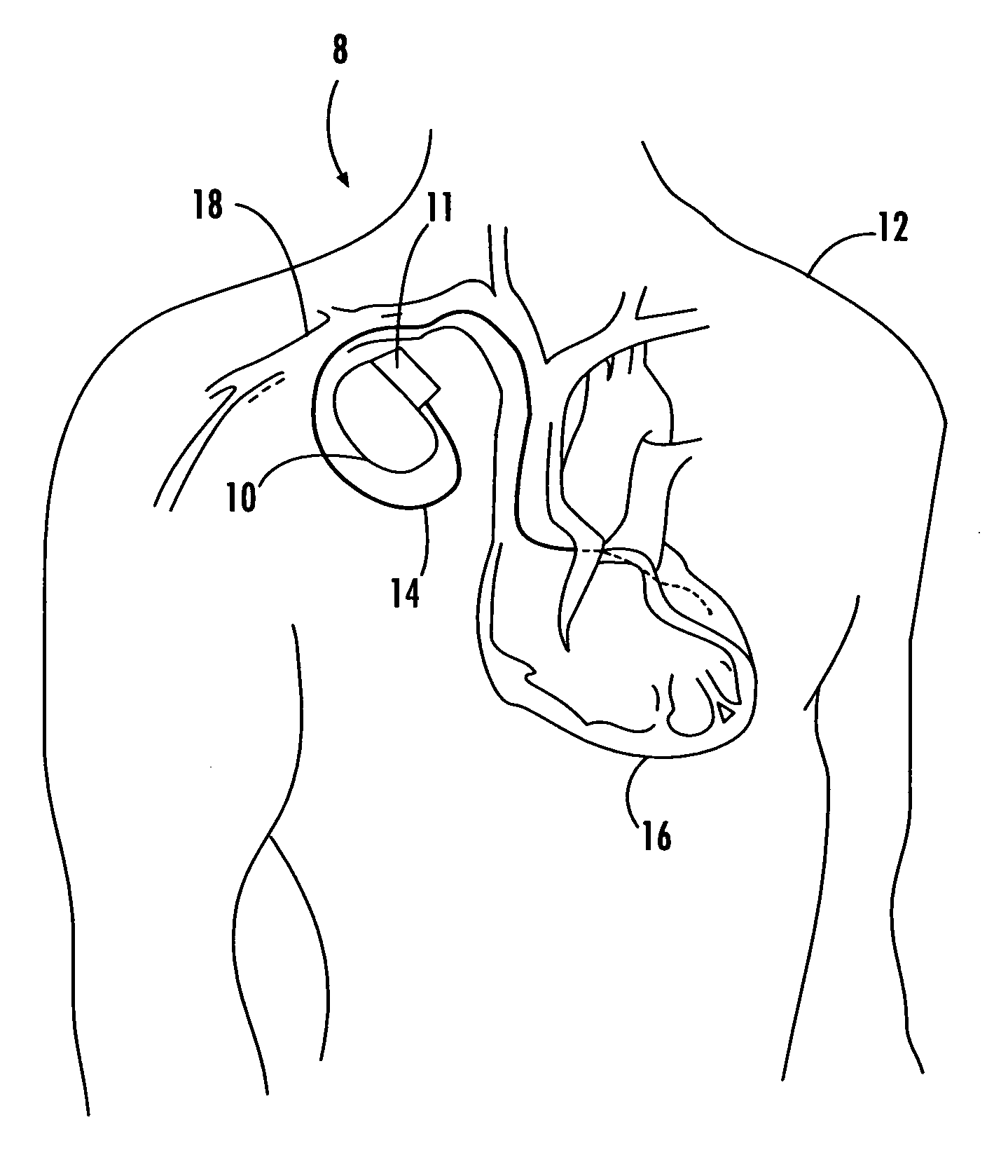 Method and apparatus for reliably placing and adjusting a left ventricular pacemaker lead
