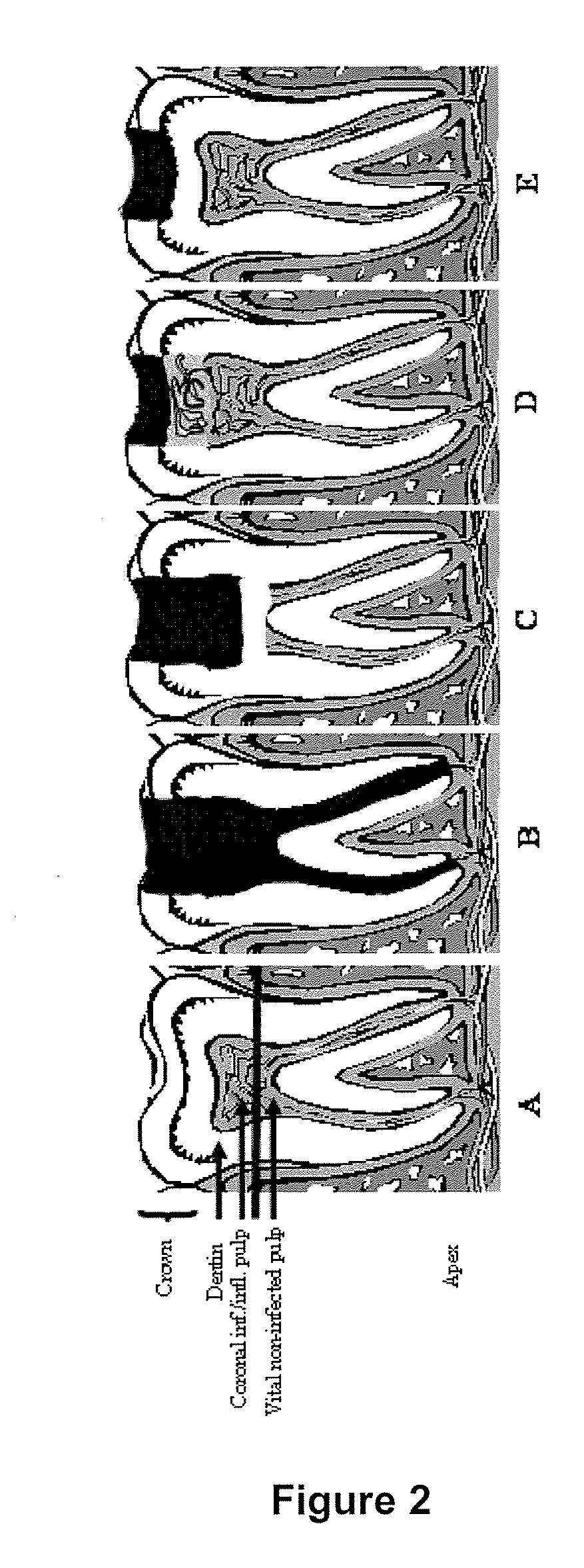 Compositions and methods for treating pulp inflammations caused by infection or trauma