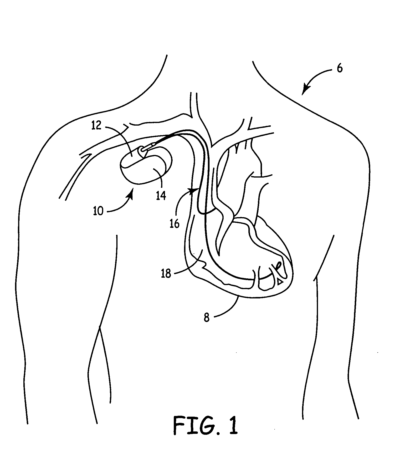 Implantable medical device with ventricular pacing protocol including progressive conduction search