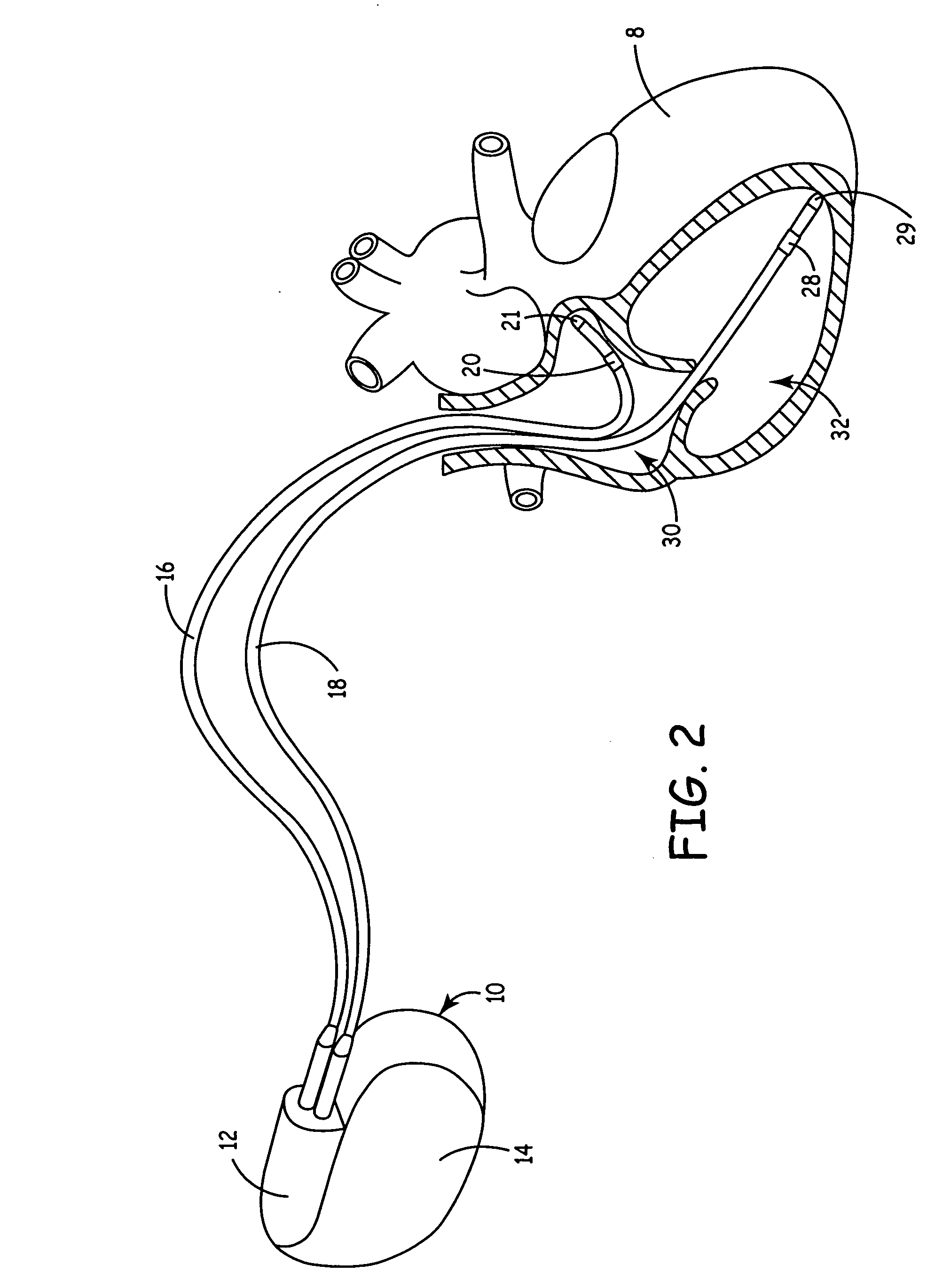 Implantable medical device with ventricular pacing protocol including progressive conduction search