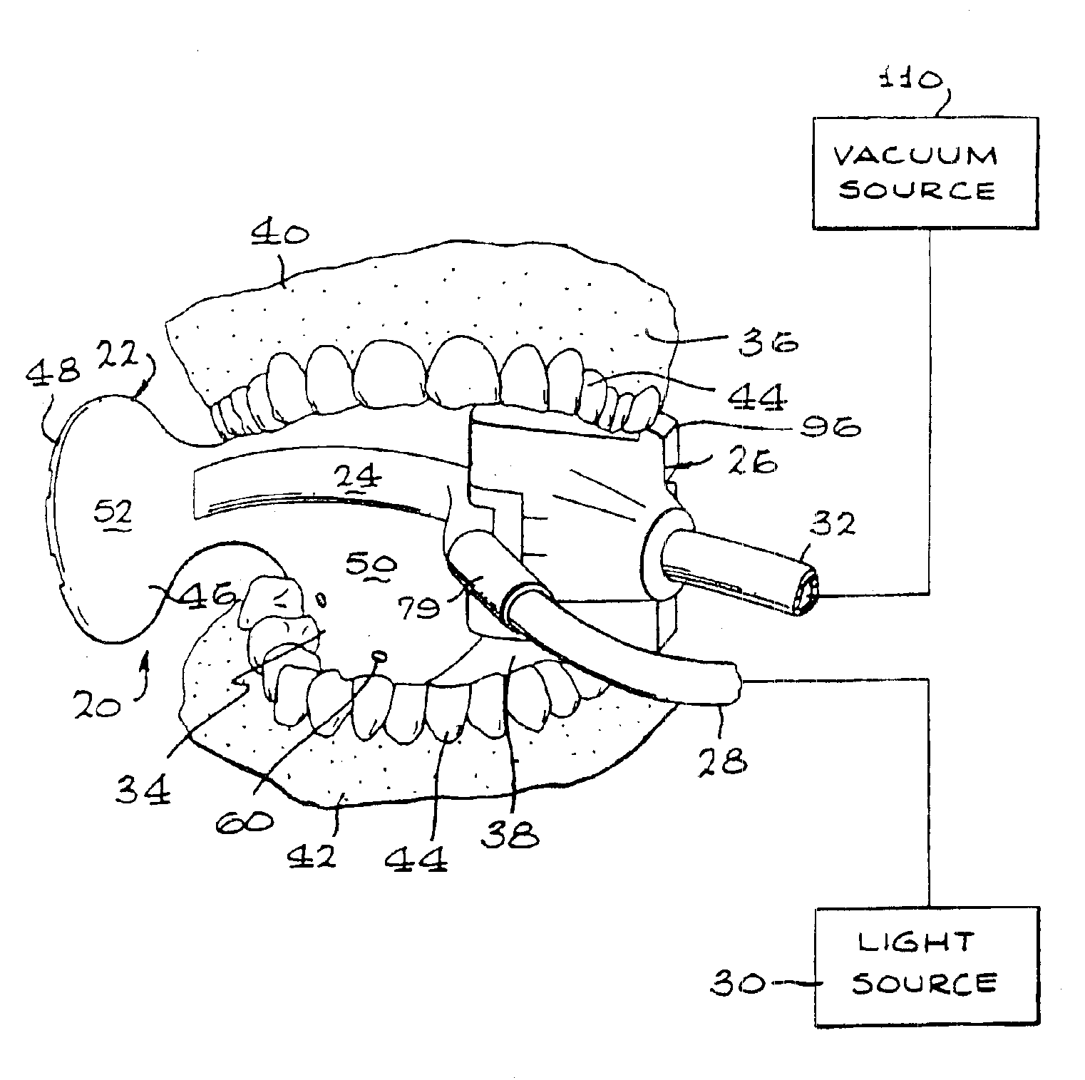 Intraoral device and method of using the same