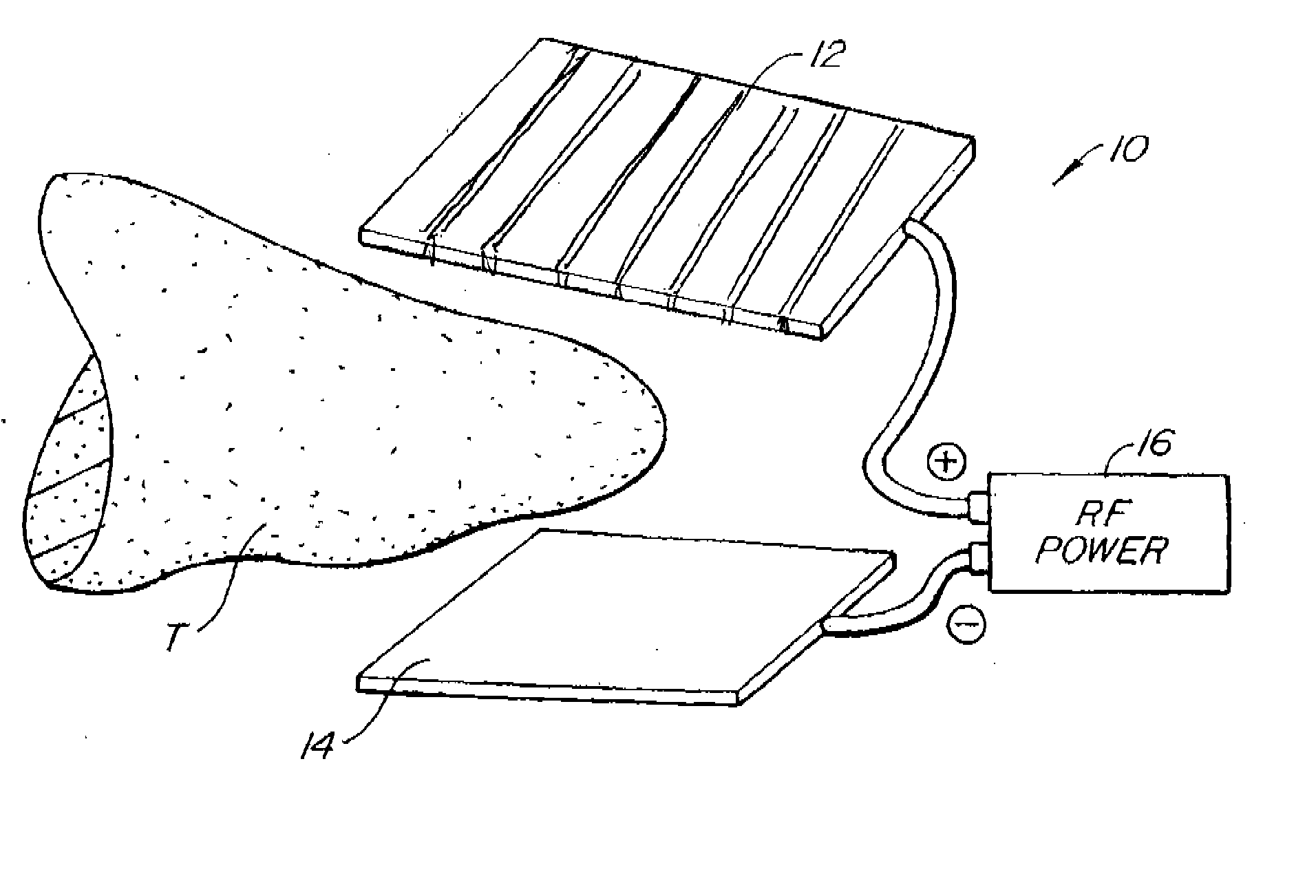 Apparatus for Tissue Cauterization