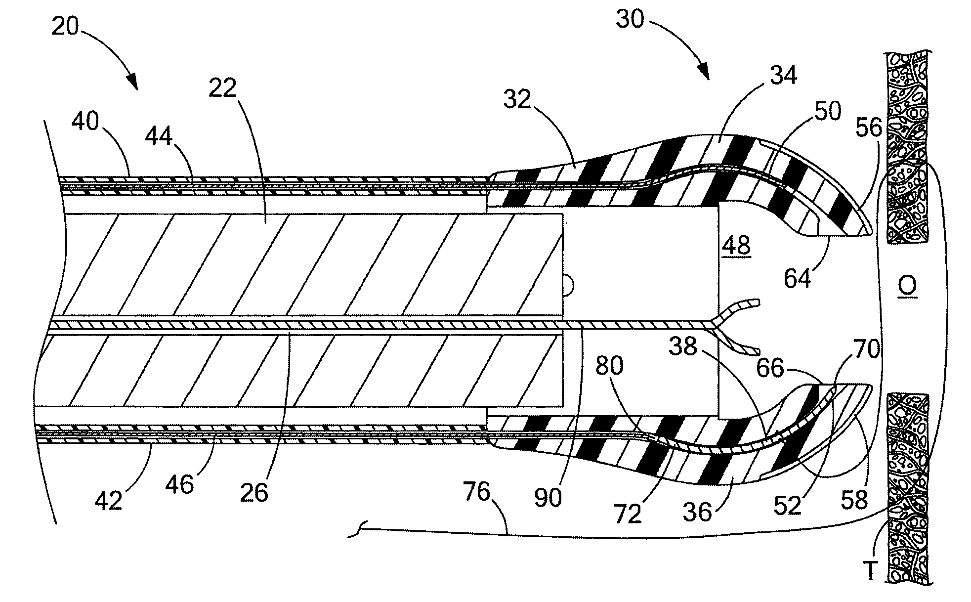 Medical devices and methods for suturing tissue