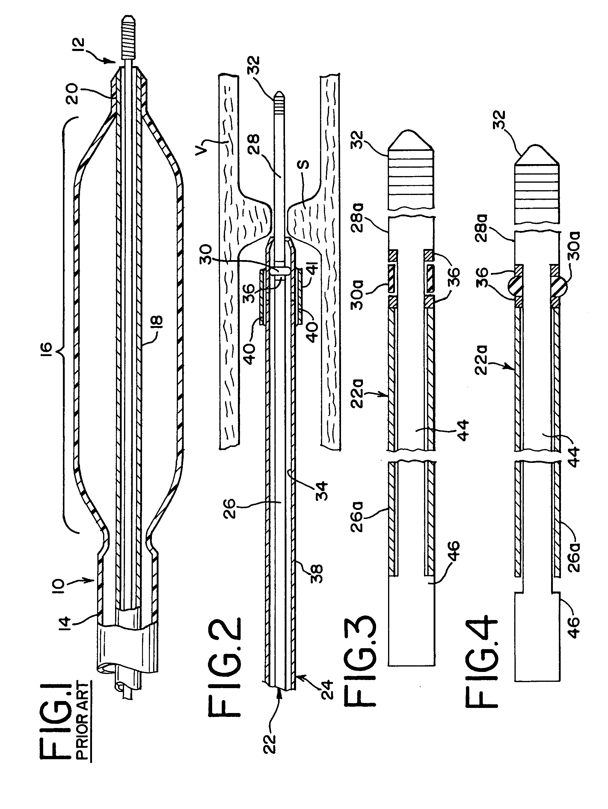 Guidewire with distal expansion feature and method for enhancing the deliverability and crossability of medical devices
